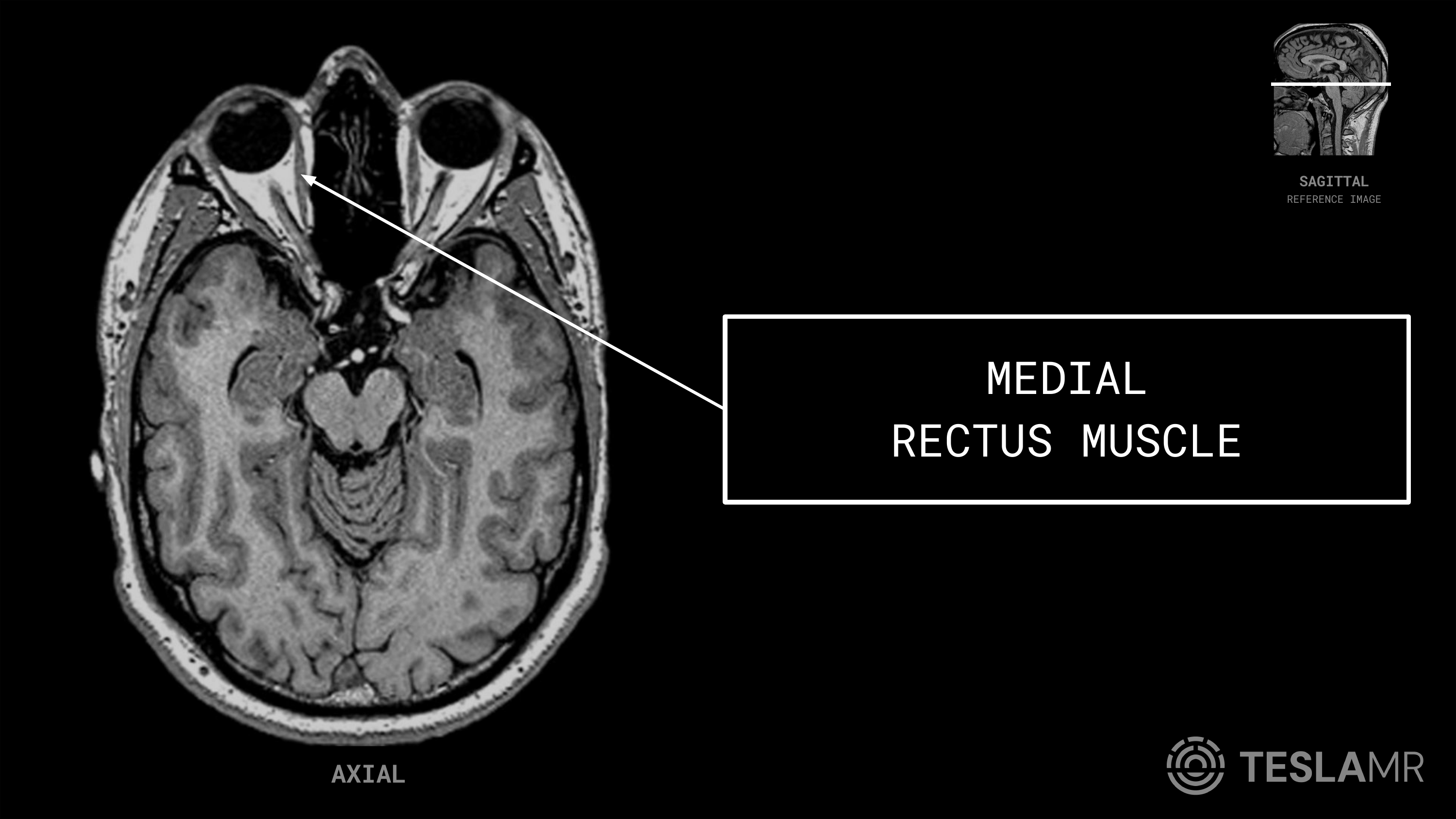 Medial Rectus Muscle labeled on a Orbits MRI (Axial)