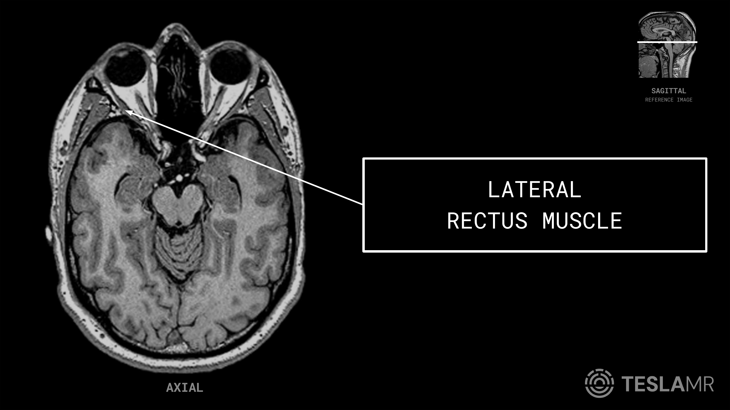 Lateral Rectus Muscle labeled on a Orbits MRI (Axial)