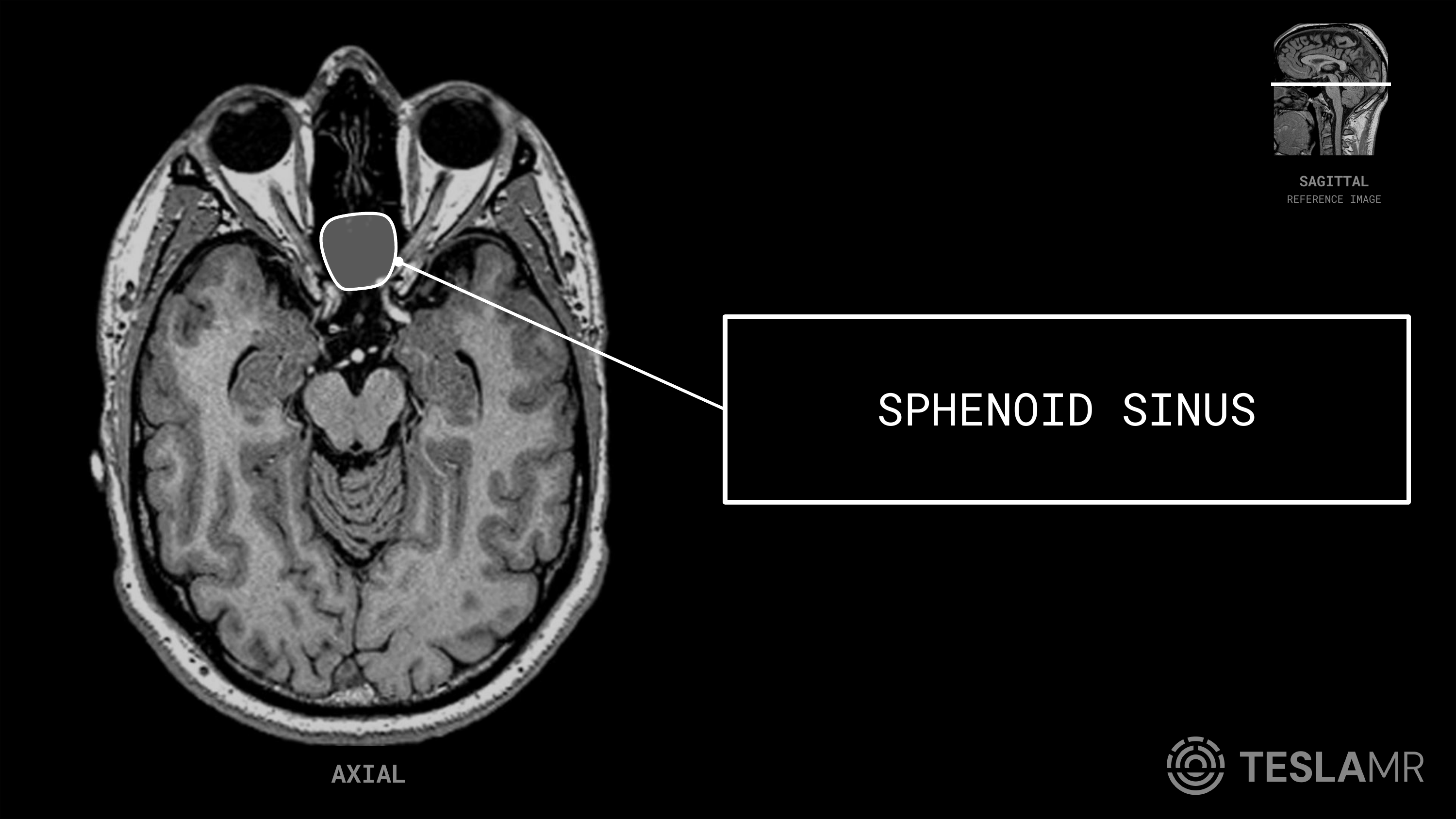 Sphenoid Sinus labeled on a Orbits MRI (Axial)