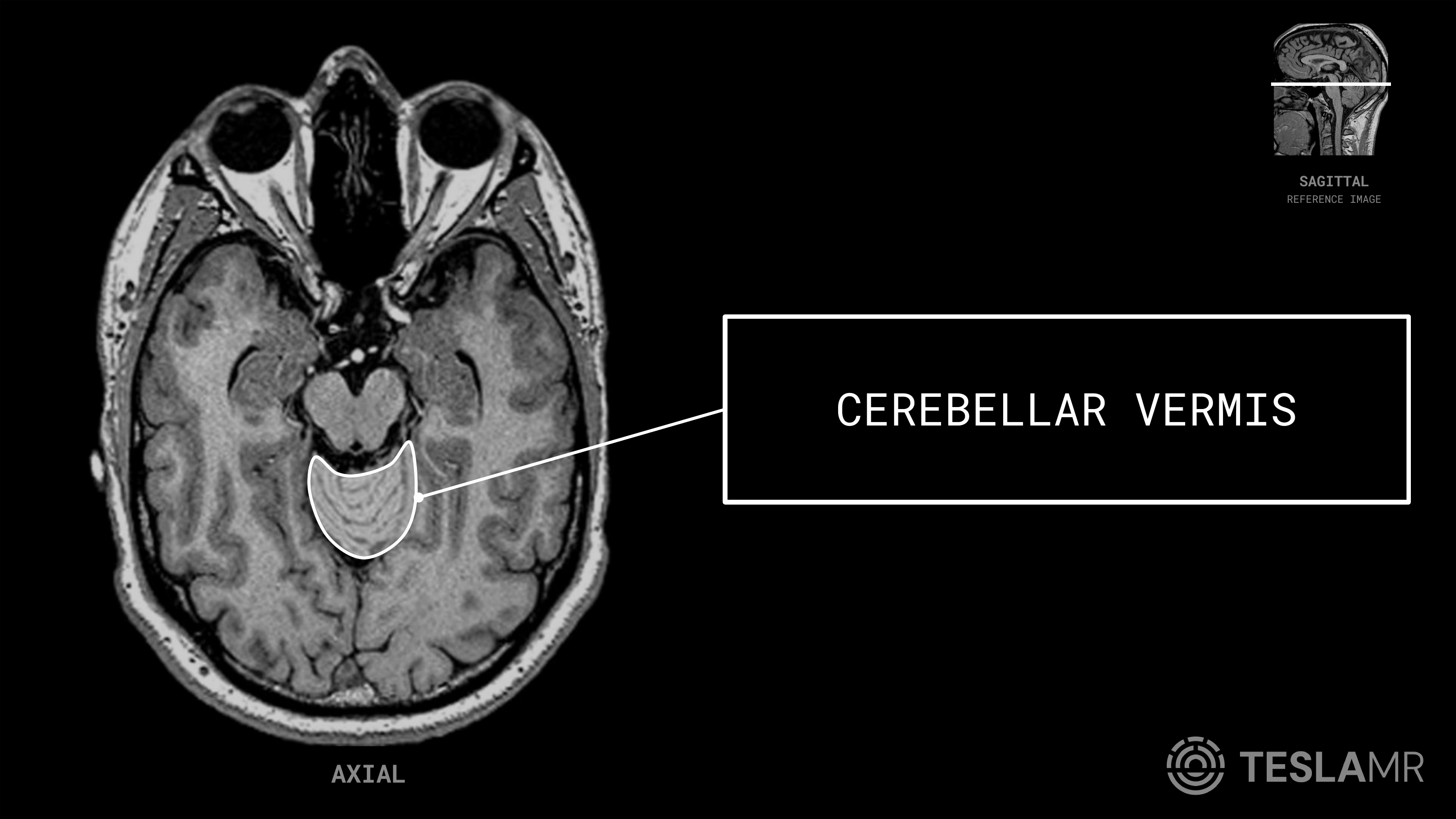 Cerebellar Vermis labeled on a Orbits MRI (Axial)