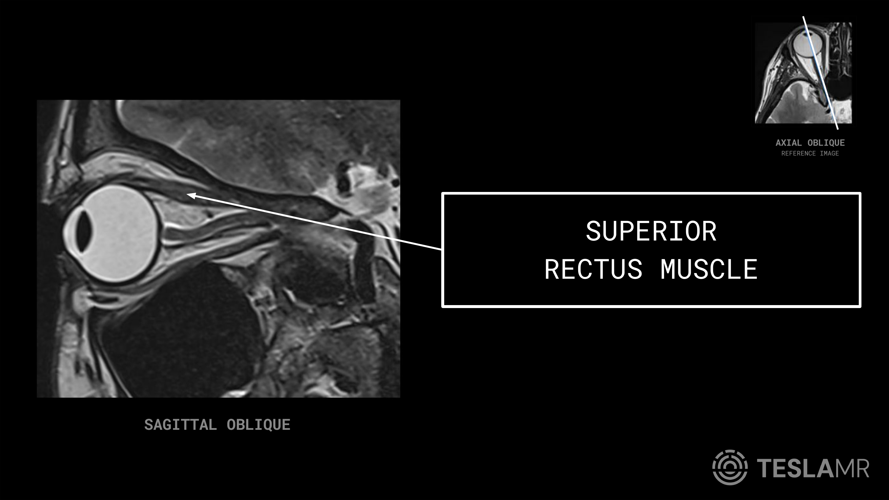 Superior Rectus Muscle labeled on a Orbits MRI (Sagittal Oblique)