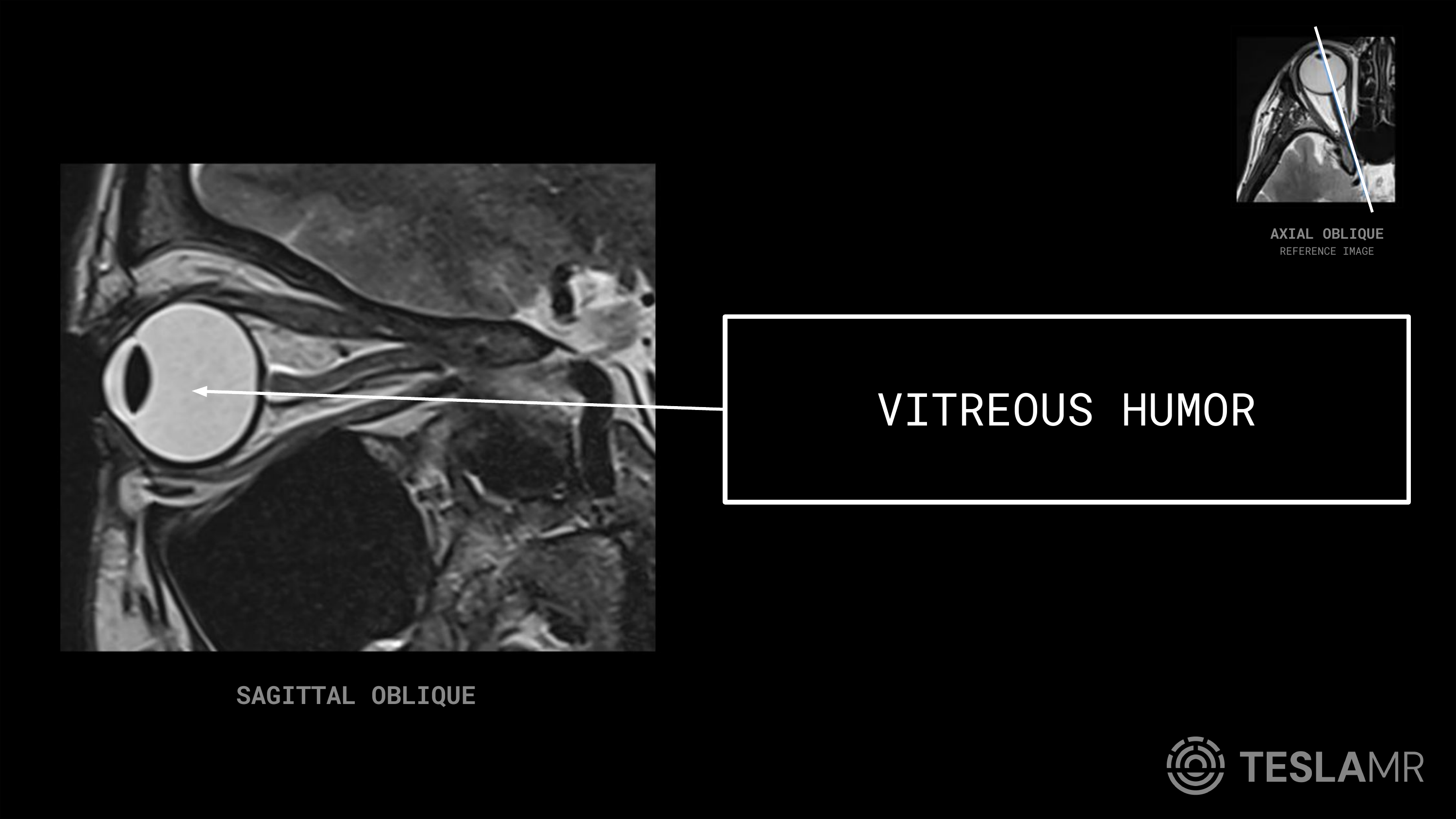 Vitreous Humor labeled on a Orbits MRI (Sagittal Oblique)