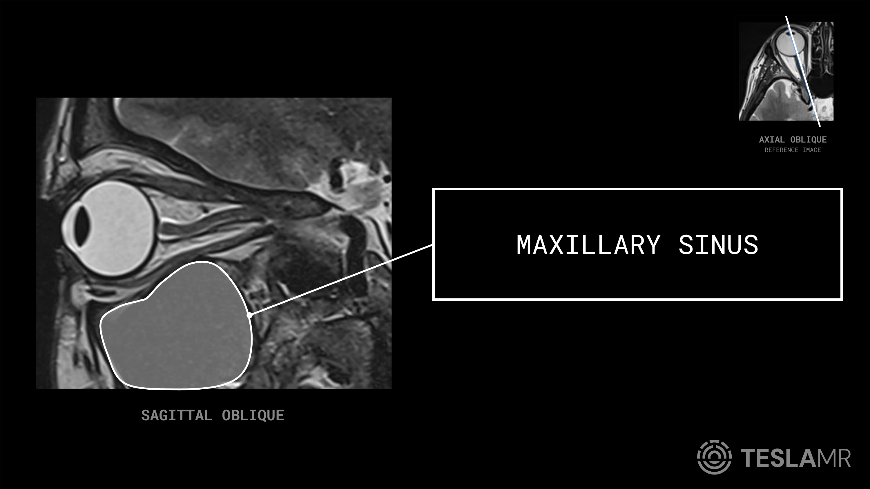 Maxillary Sinus labeled on a Orbits MRI (Sagittal Oblique)