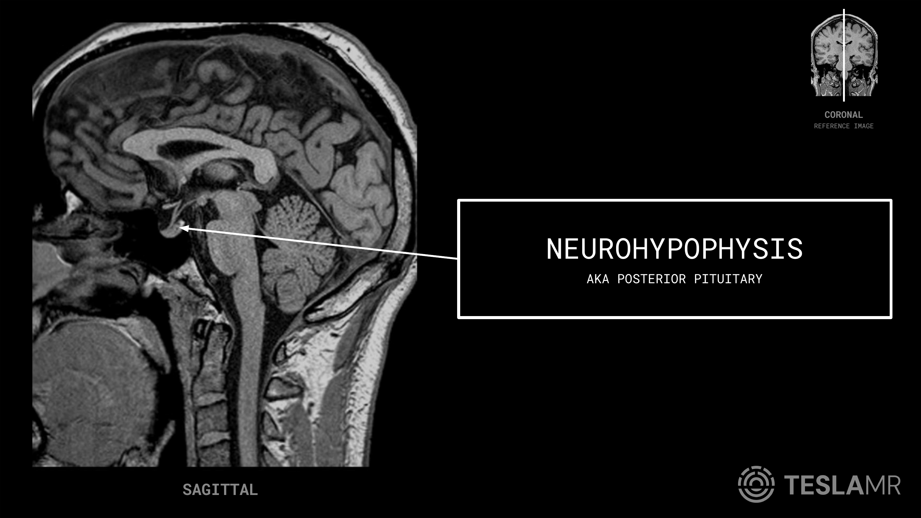 Neurohypophysis labeled on a Pituitary MRI (Sagittal)