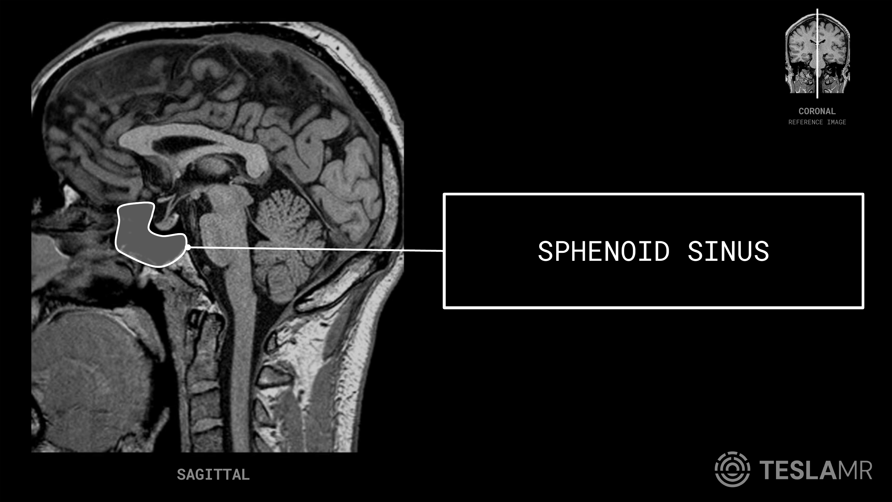 Sphenoid Sinus labeled on a Pituitary MRI (Sagittal)
