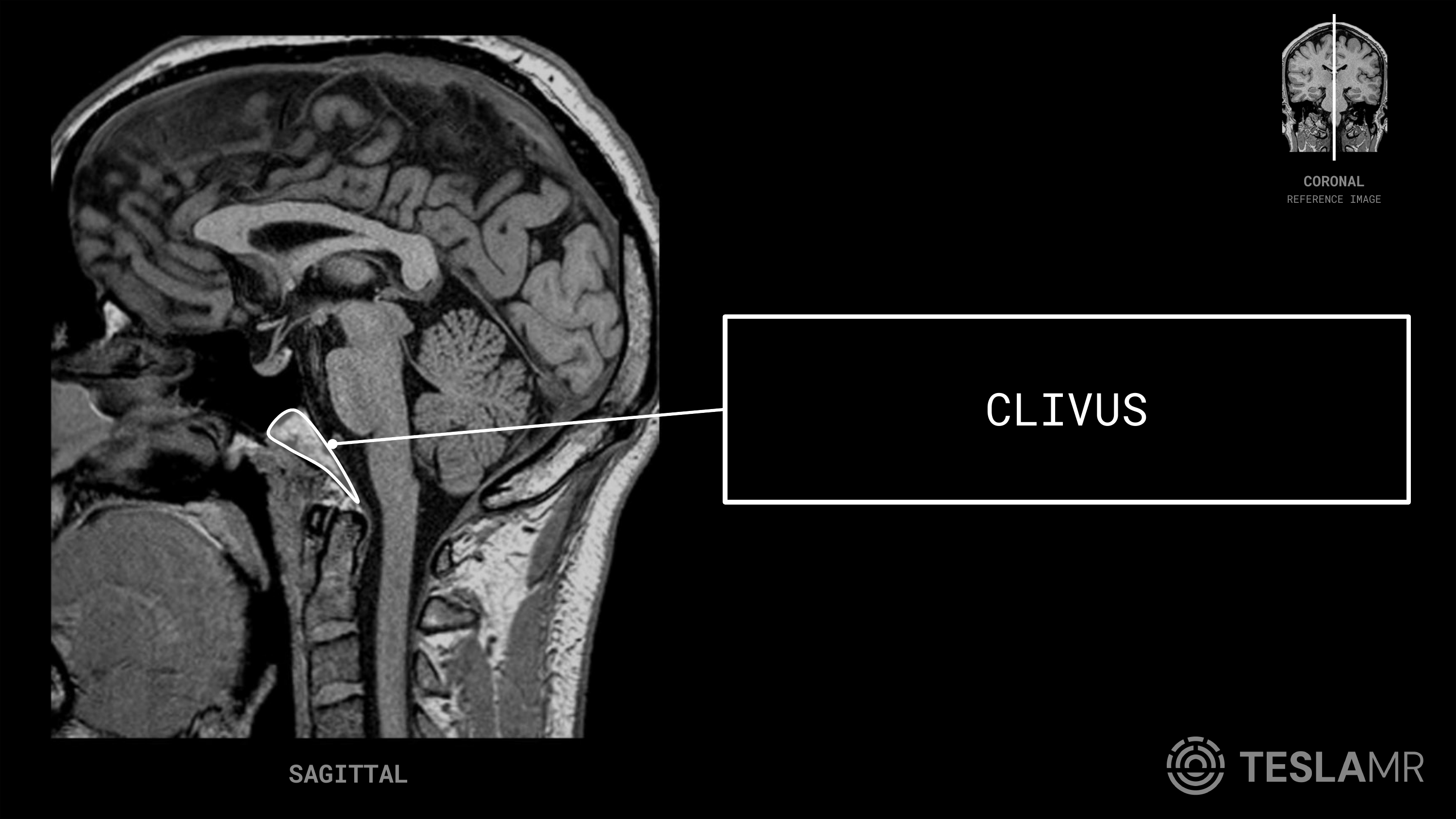Clivus labeled on a Pituitary MRI (Sagittal)