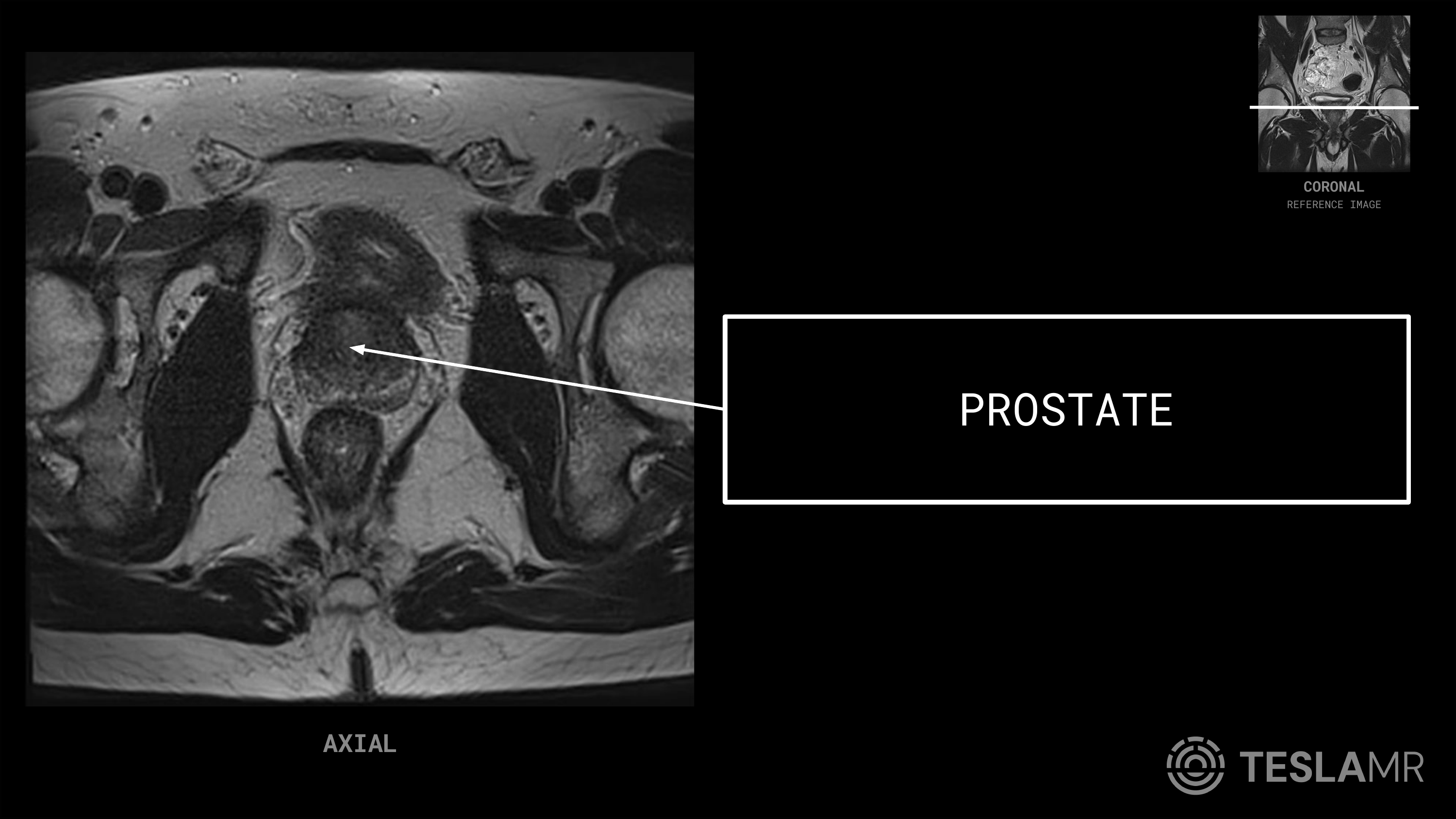 Prostate labeled on a Prostate MRI (Axial · Sagittal)
