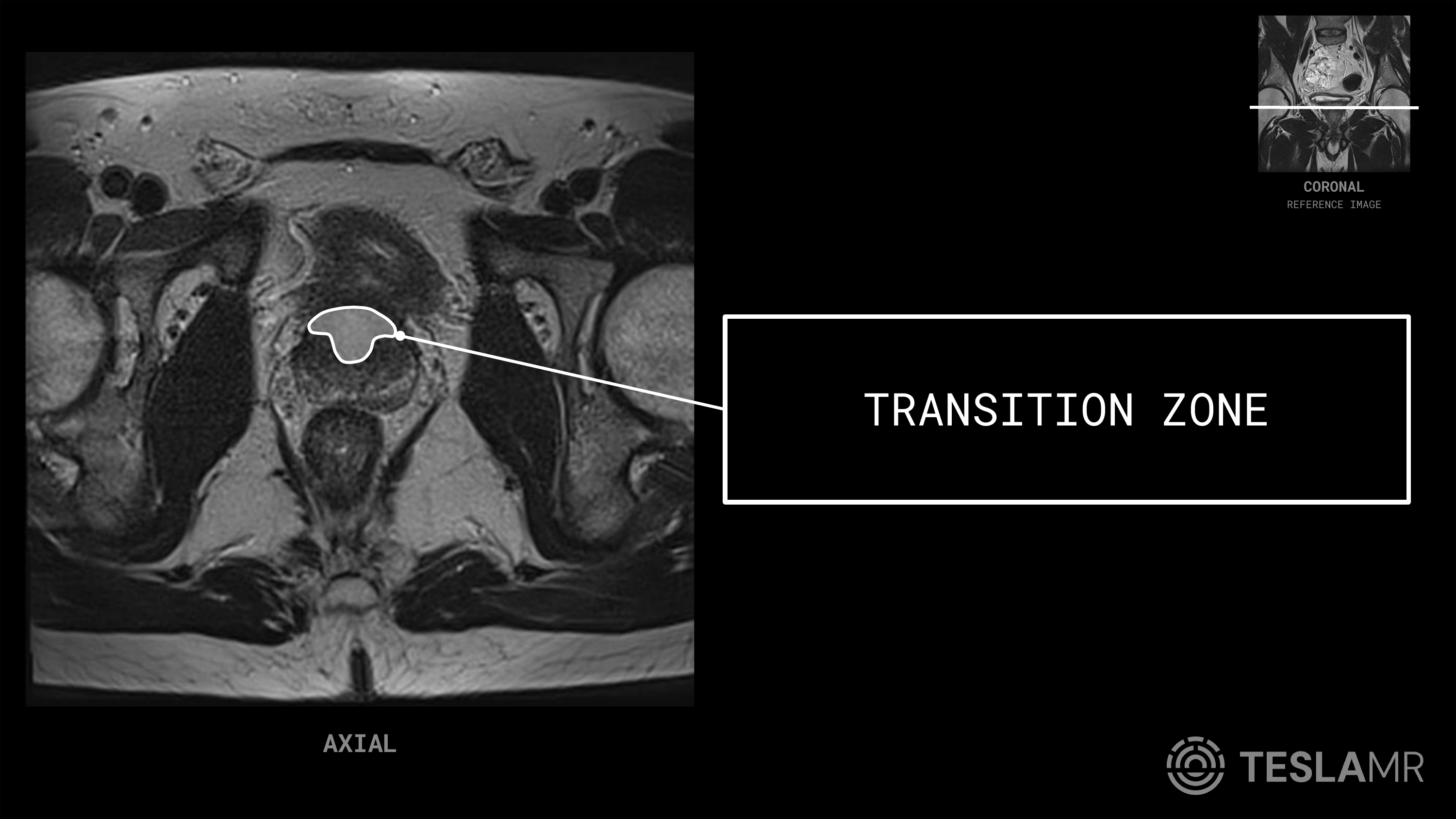 Transition Zone labeled on a Prostate MRI (Axial · Sagittal)
