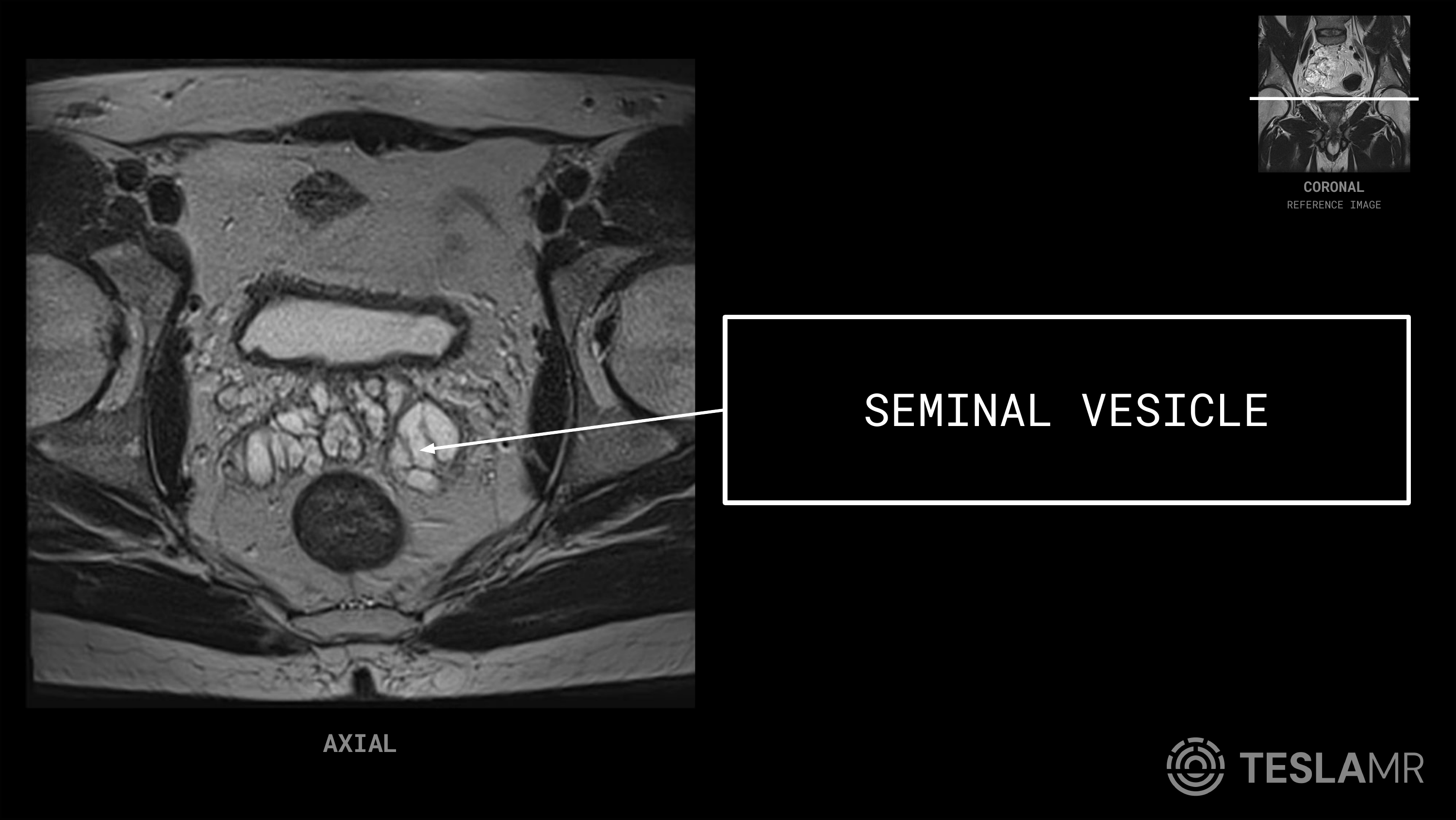 Seminal Vesicle labeled on a Prostate MRI (Axial · Sagittal)