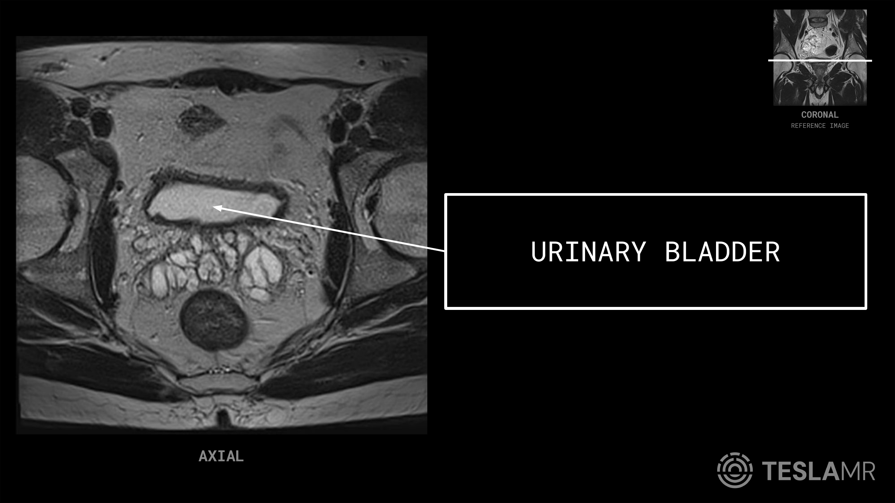 Urinary Bladder labeled on a Prostate MRI (Axial)
