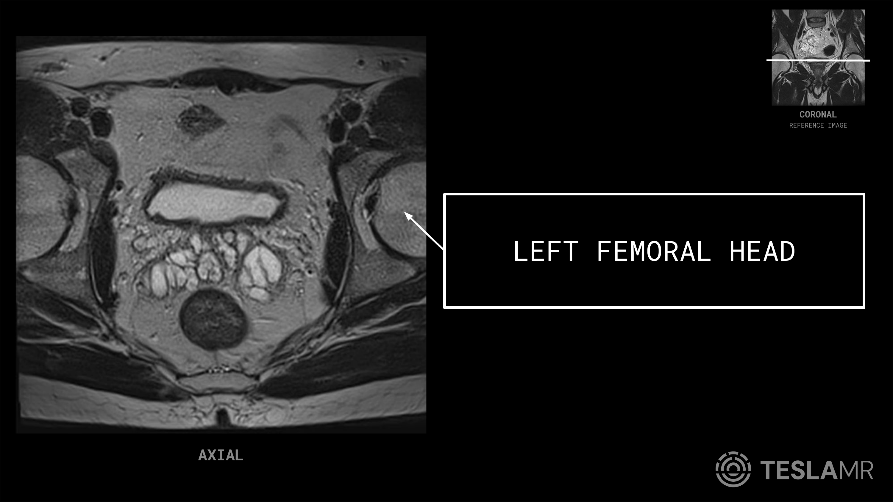 Left Femoral Head labeled on a Prostate MRI (Axial)