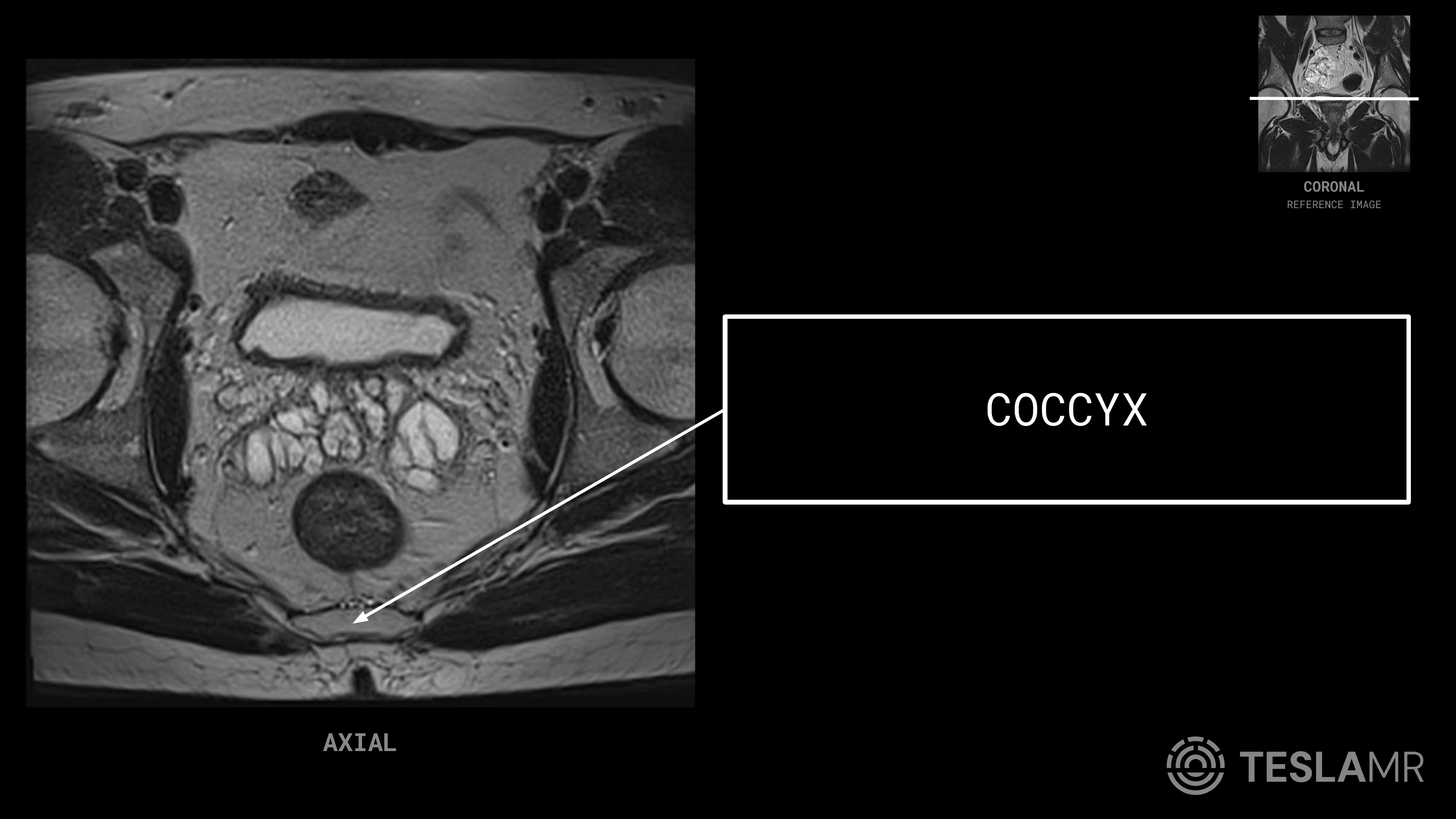 Coccyx labeled on a Prostate MRI (Axial · Sagittal)