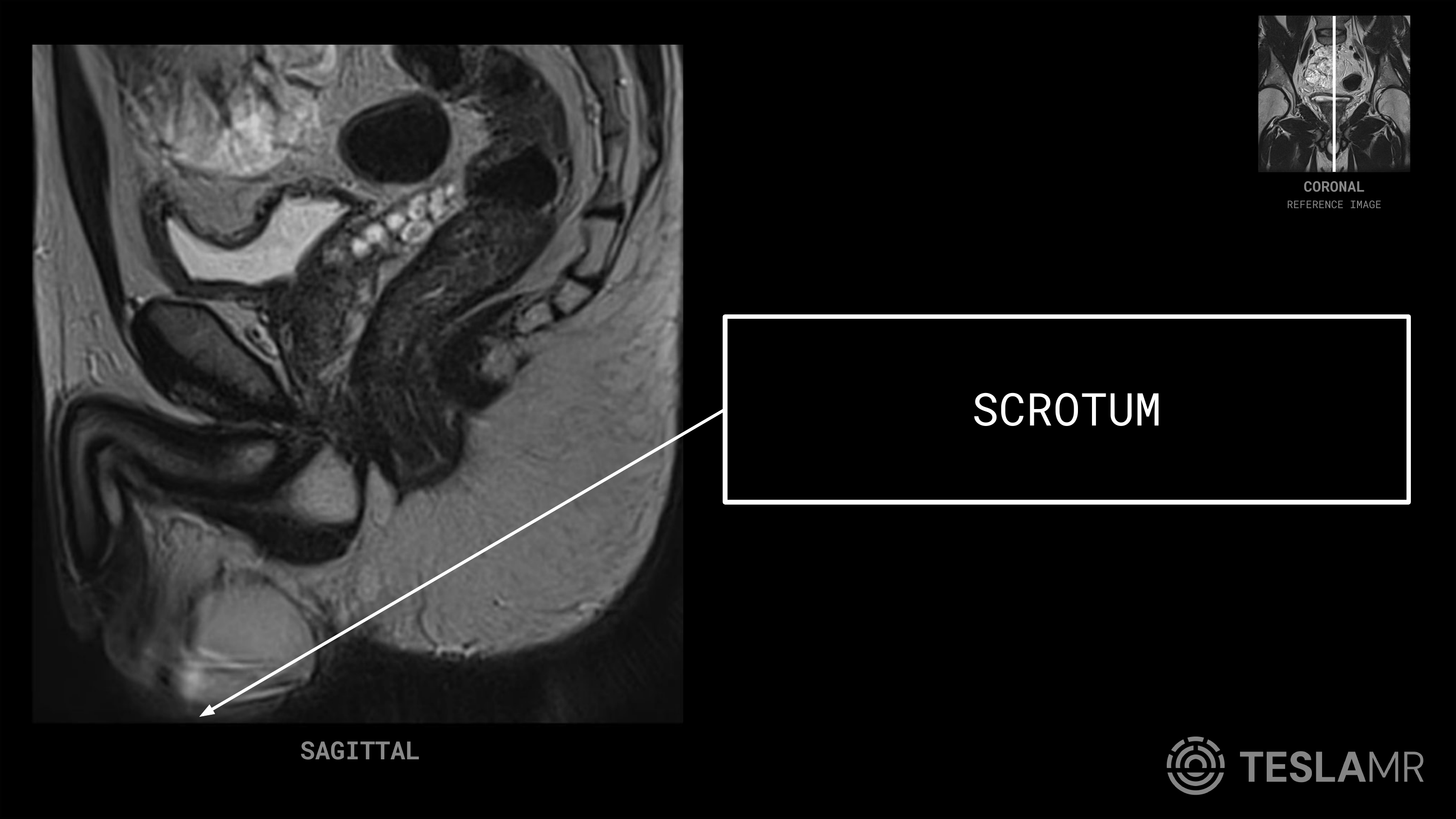 Scrotum labeled on a Prostate MRI (Sagittal)
