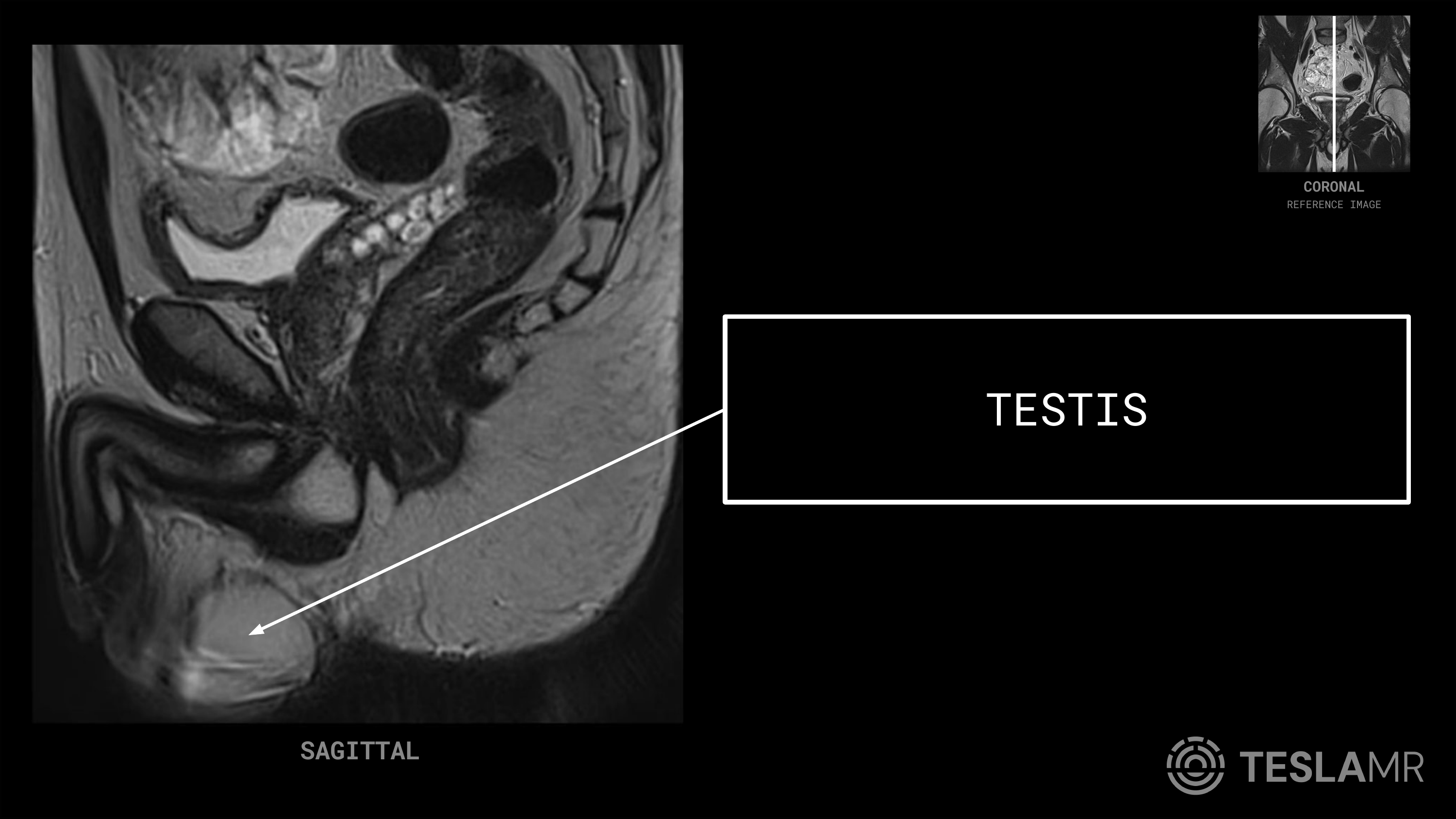 Testis labeled on a Prostate MRI (Sagittal)