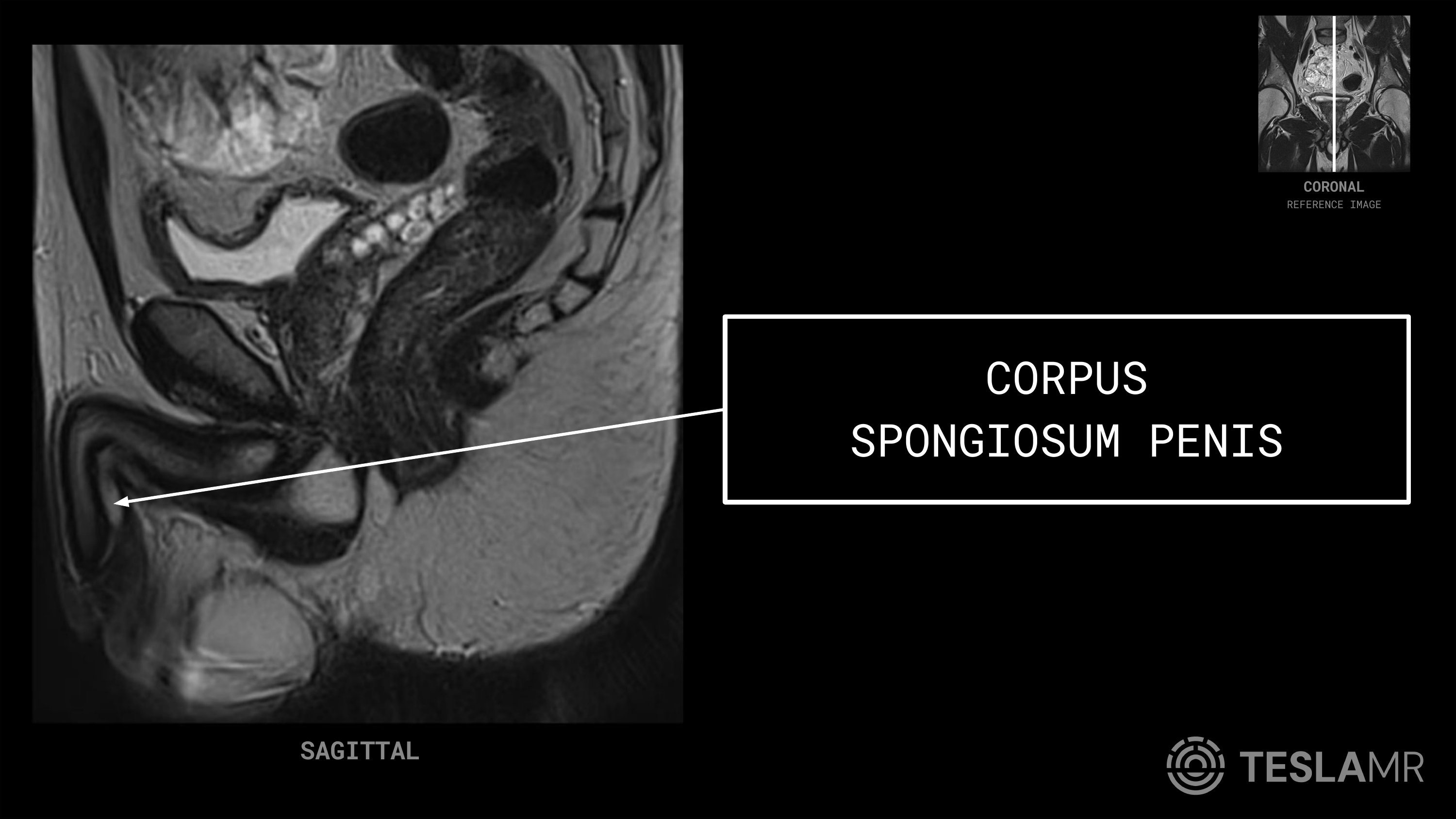 Corpus Spongiosum Penis labeled on a Prostate MRI (Sagittal)