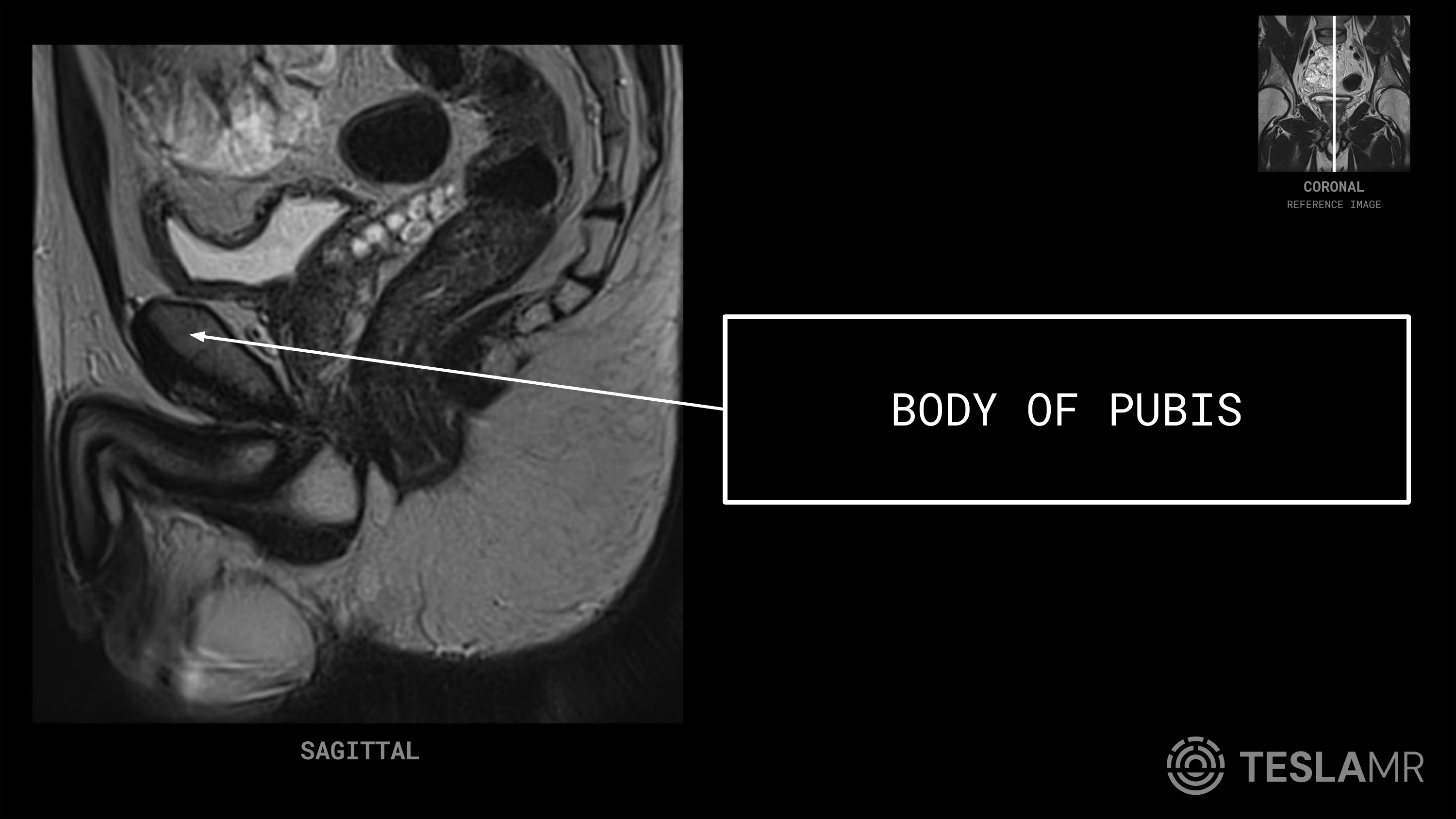Body of Pubis labeled on a Prostate MRI (Sagittal)