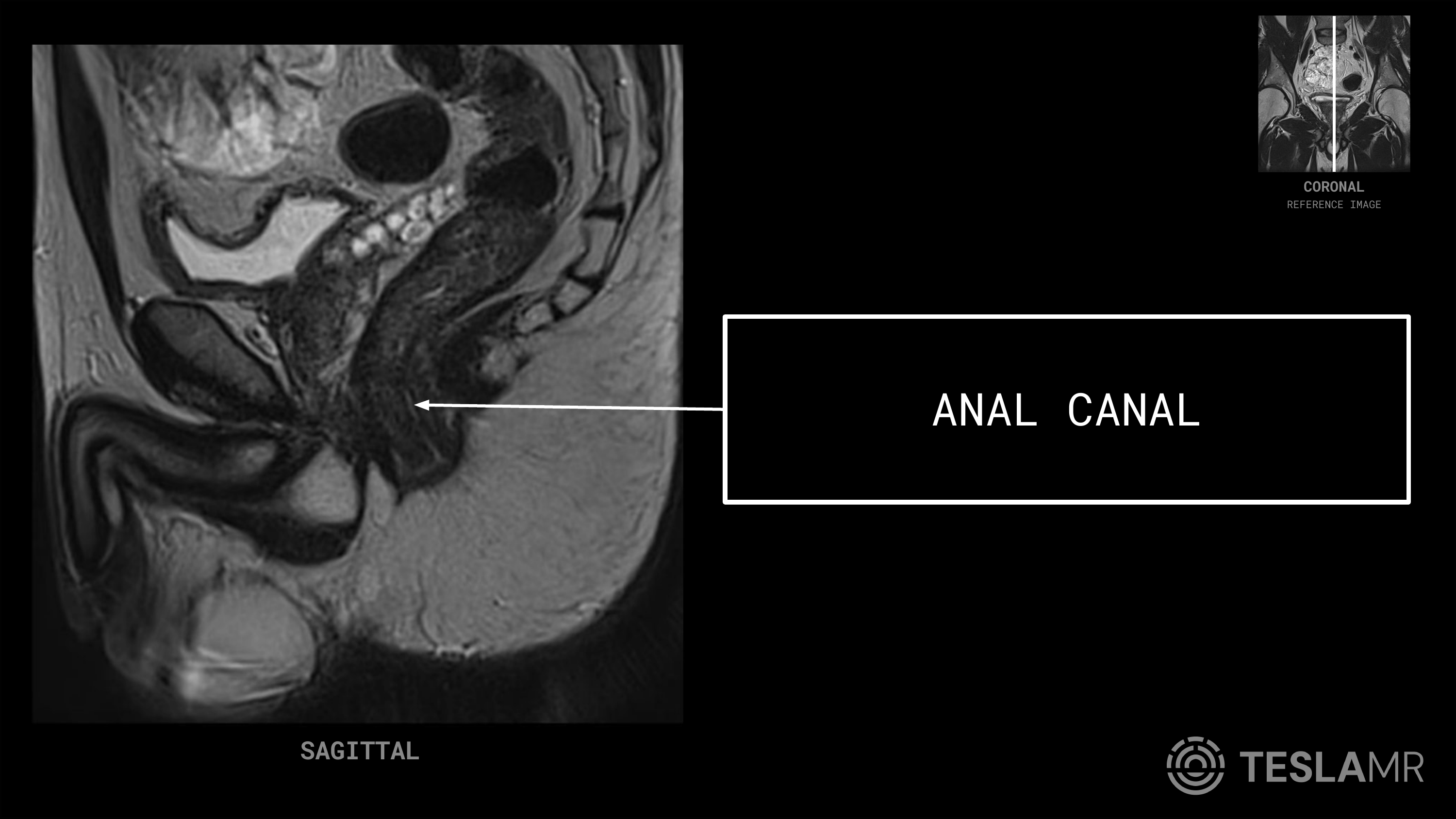 Anal Canal labeled on a Prostate MRI (Sagittal)