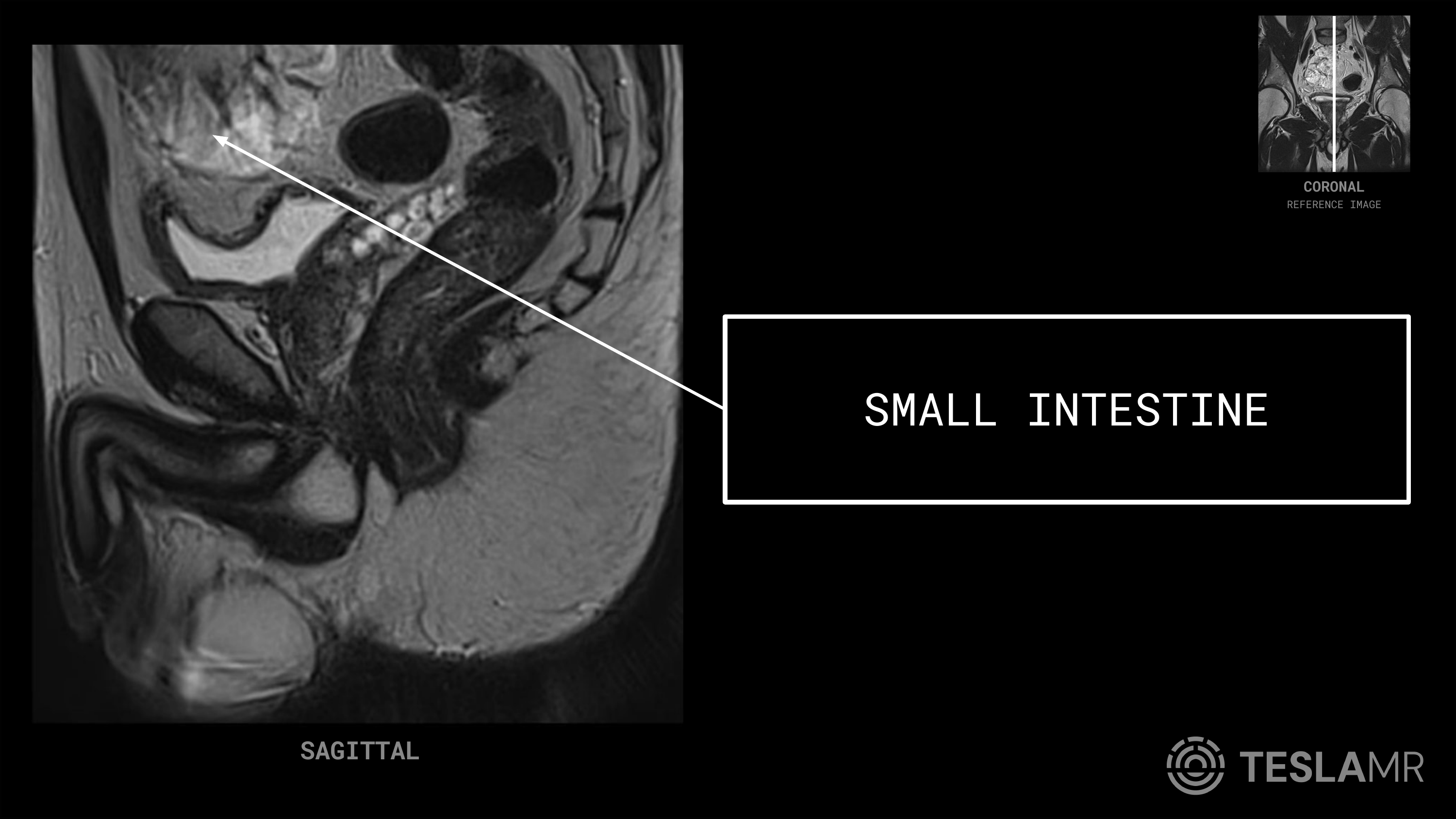 Small Intestine labeled on a Prostate MRI (Sagittal)