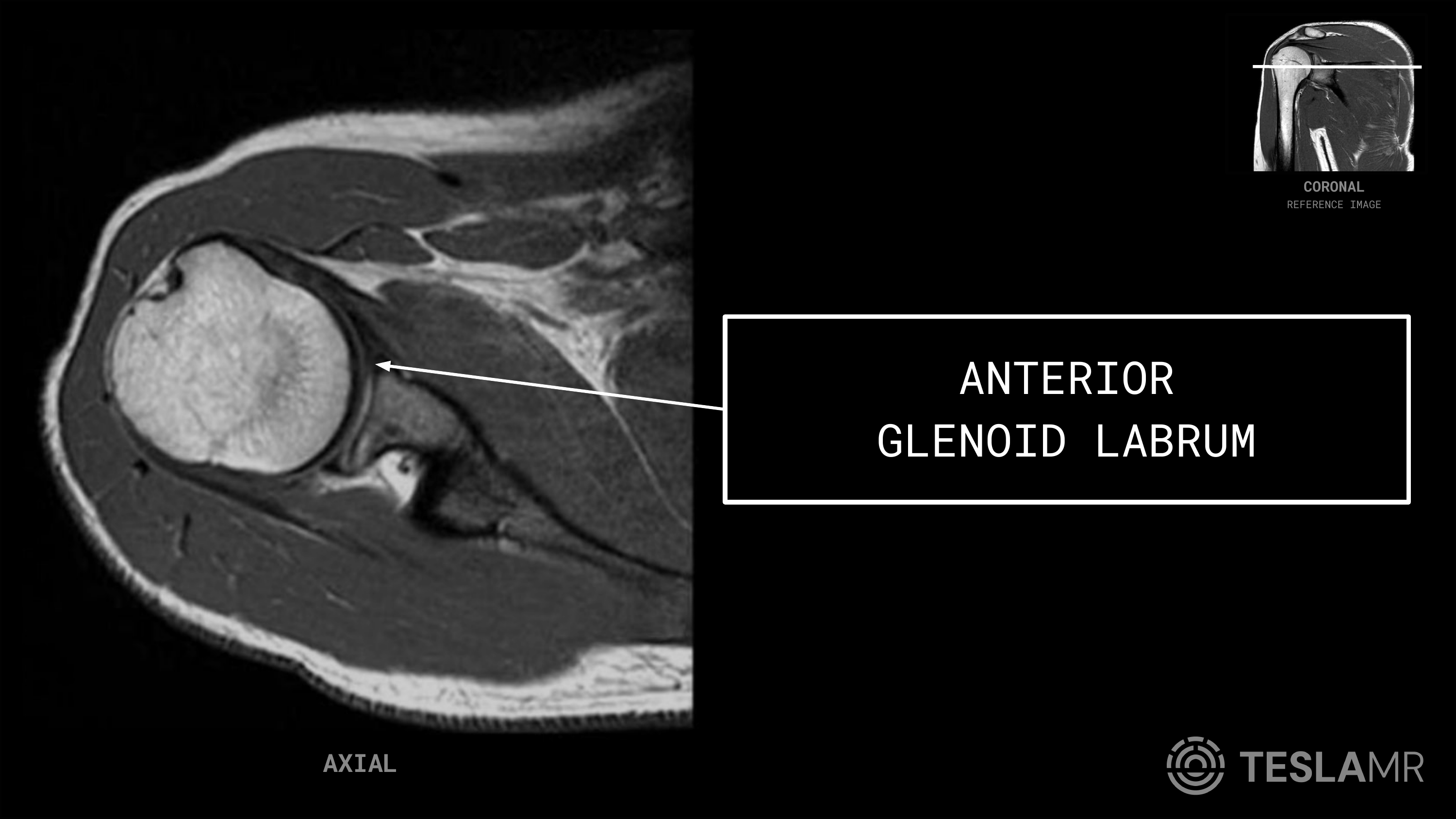Anterior Glenoid Labrum labeled on a Shoulder MRI (Axial)