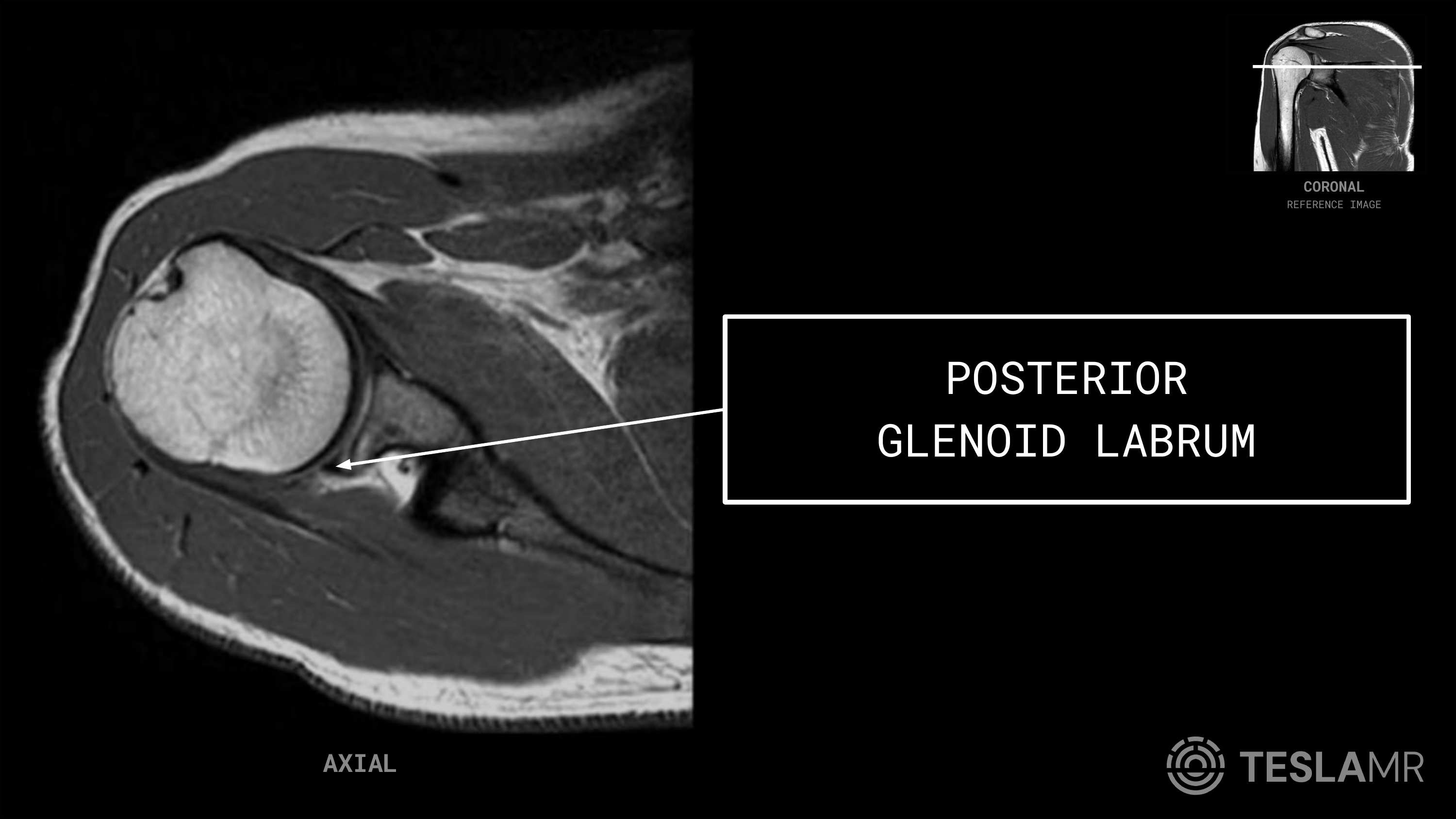 Posterior Glenoid Labrum labeled on a Shoulder MRI (Axial)