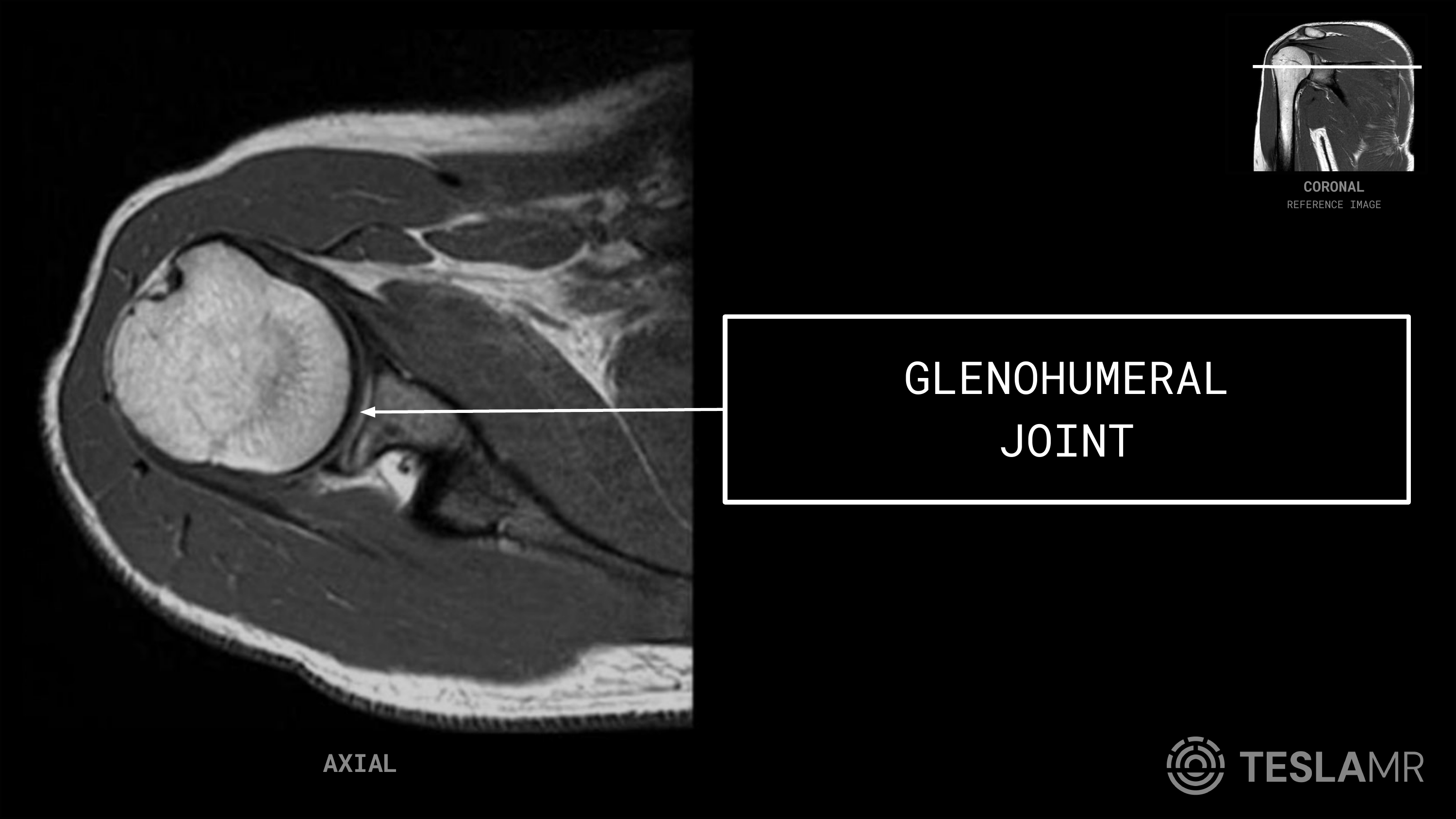 Glenohumeral Joint labeled on a Shoulder MRI (Axial)