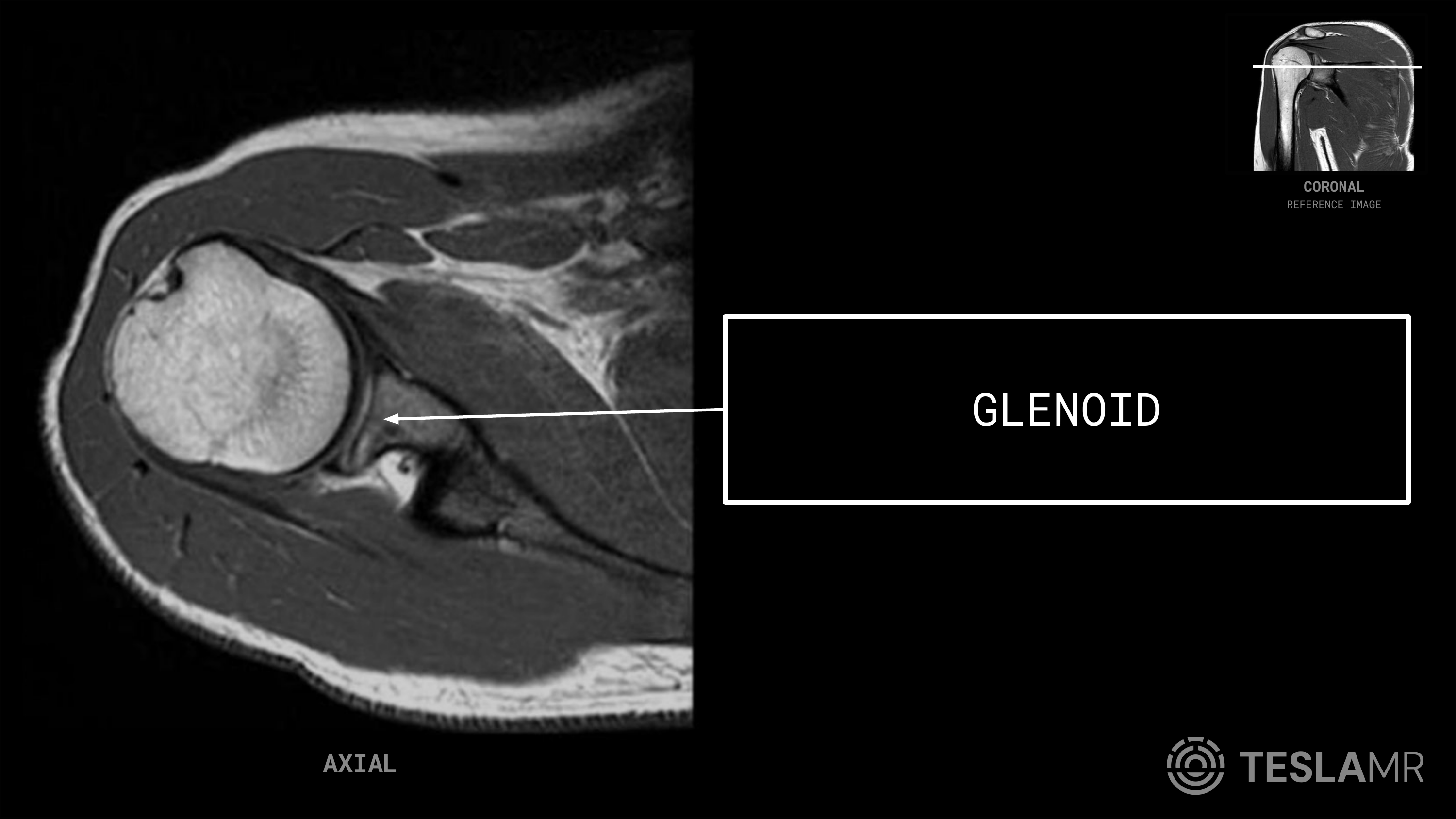 Glenoid labeled on a Shoulder MRI (Axial · Coronal Oblique)