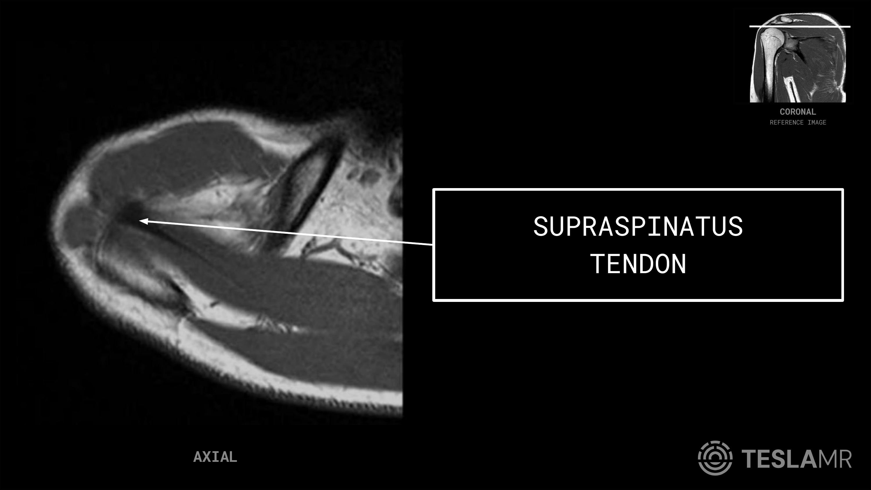 Supraspinatus Tendon labeled on a Shoulder MRI (Axial)