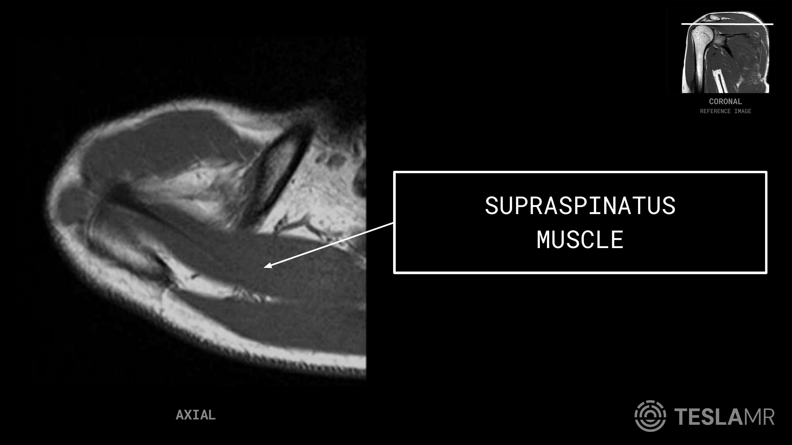 Supraspinatus Muscle labeled on a Shoulder MRI (Axial · Coronal Oblique)
