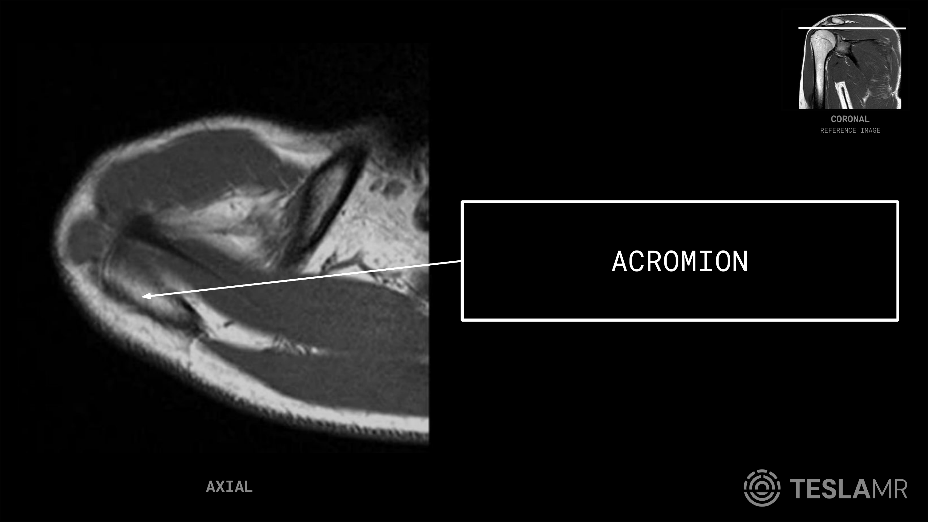 Acromion labeled on a Shoulder MRI (Axial)