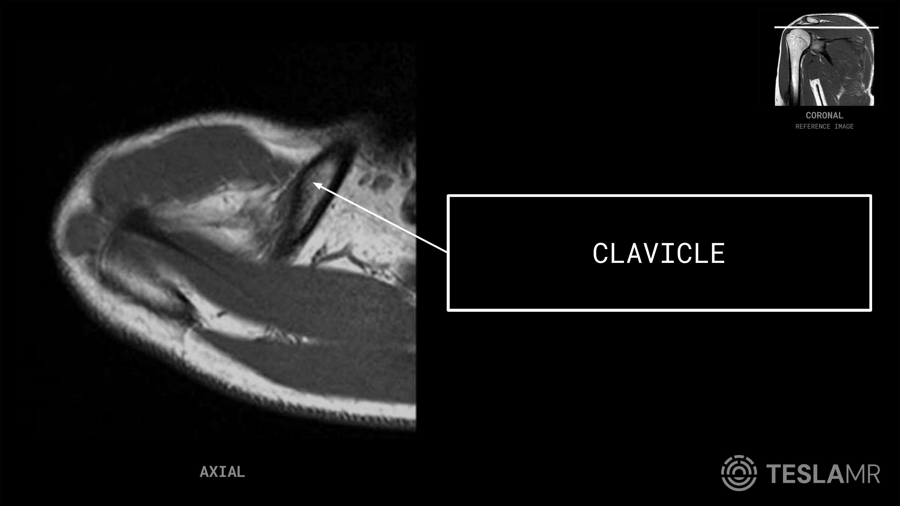 Clavicle labeled on a Shoulder MRI (Axial · Coronal Oblique)