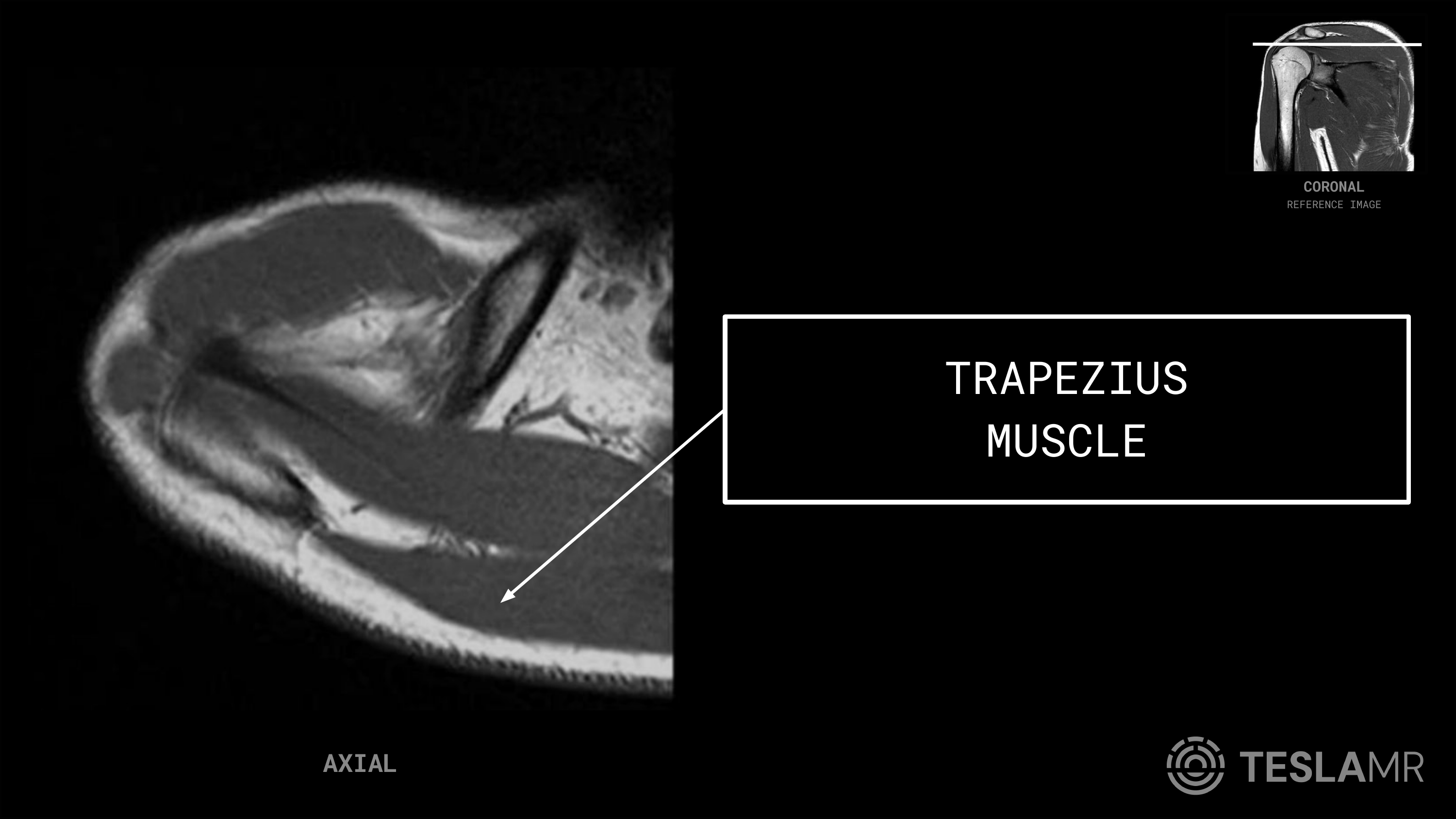 Trapezius Muscle labeled on a Shoulder MRI (Axial · Coronal Oblique)