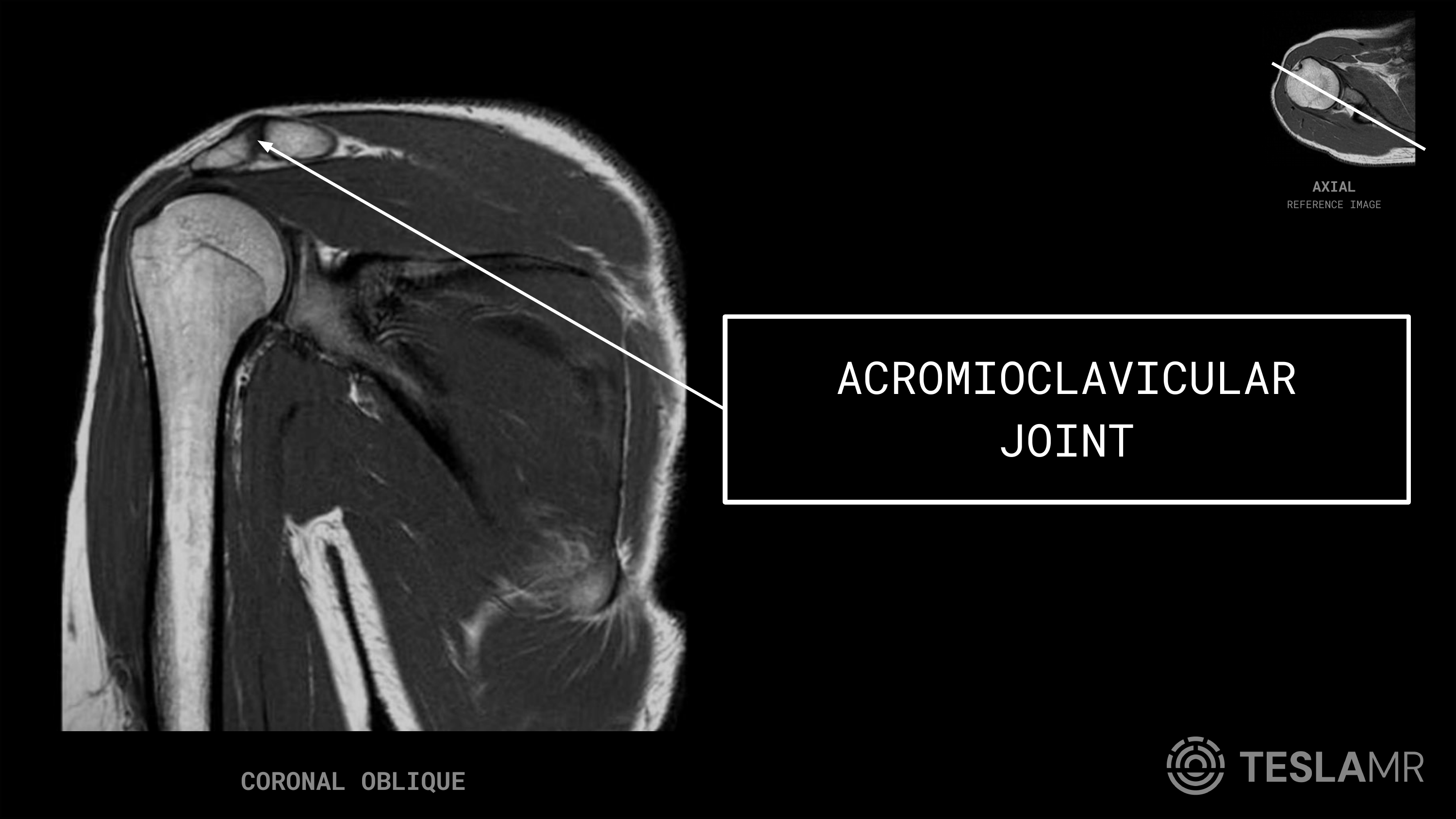 Acromioclavicular Joint labeled on a Shoulder MRI (Coronal Oblique)