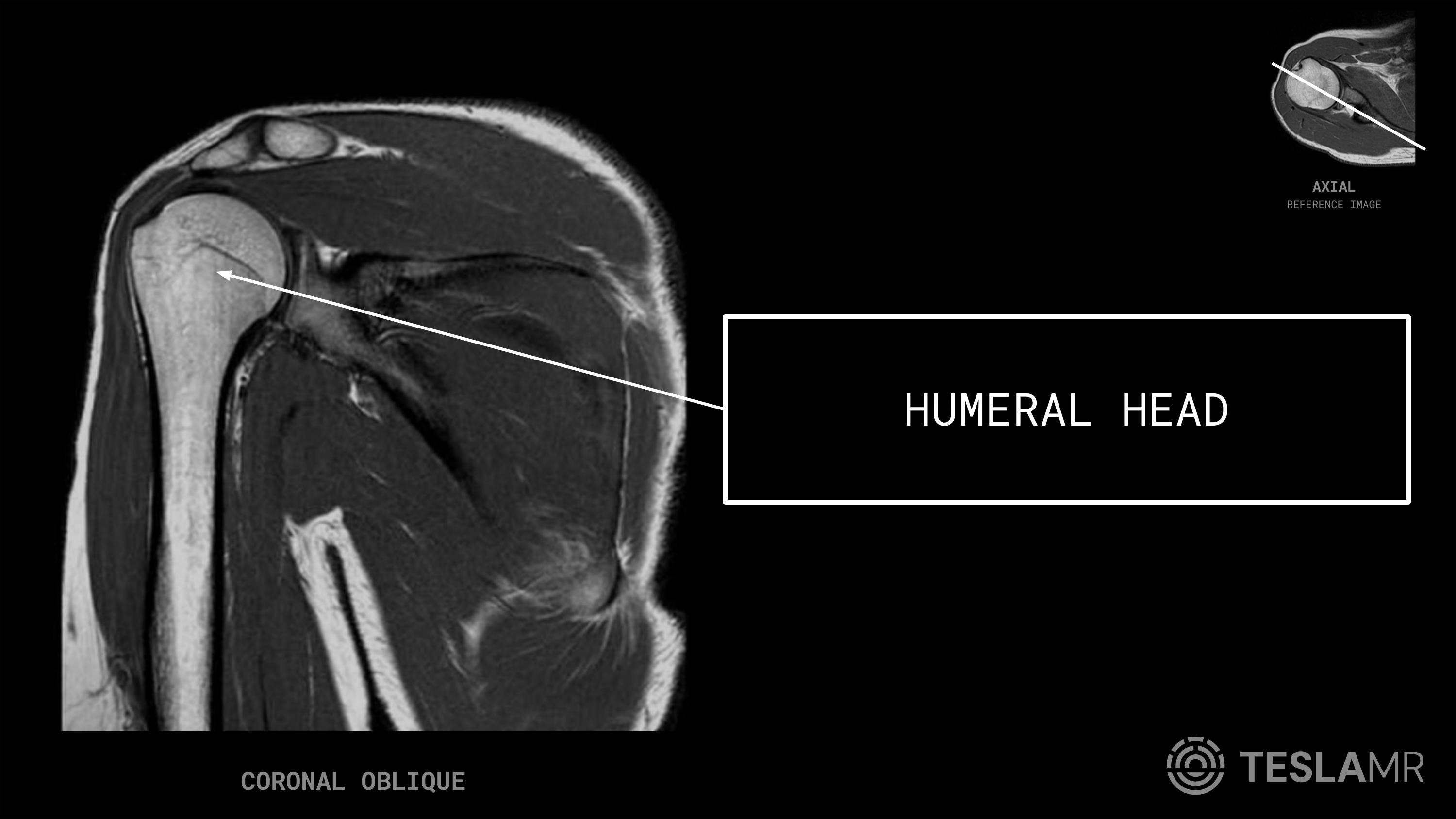 Humeral Head labeled on a Shoulder MRI (Coronal Oblique)