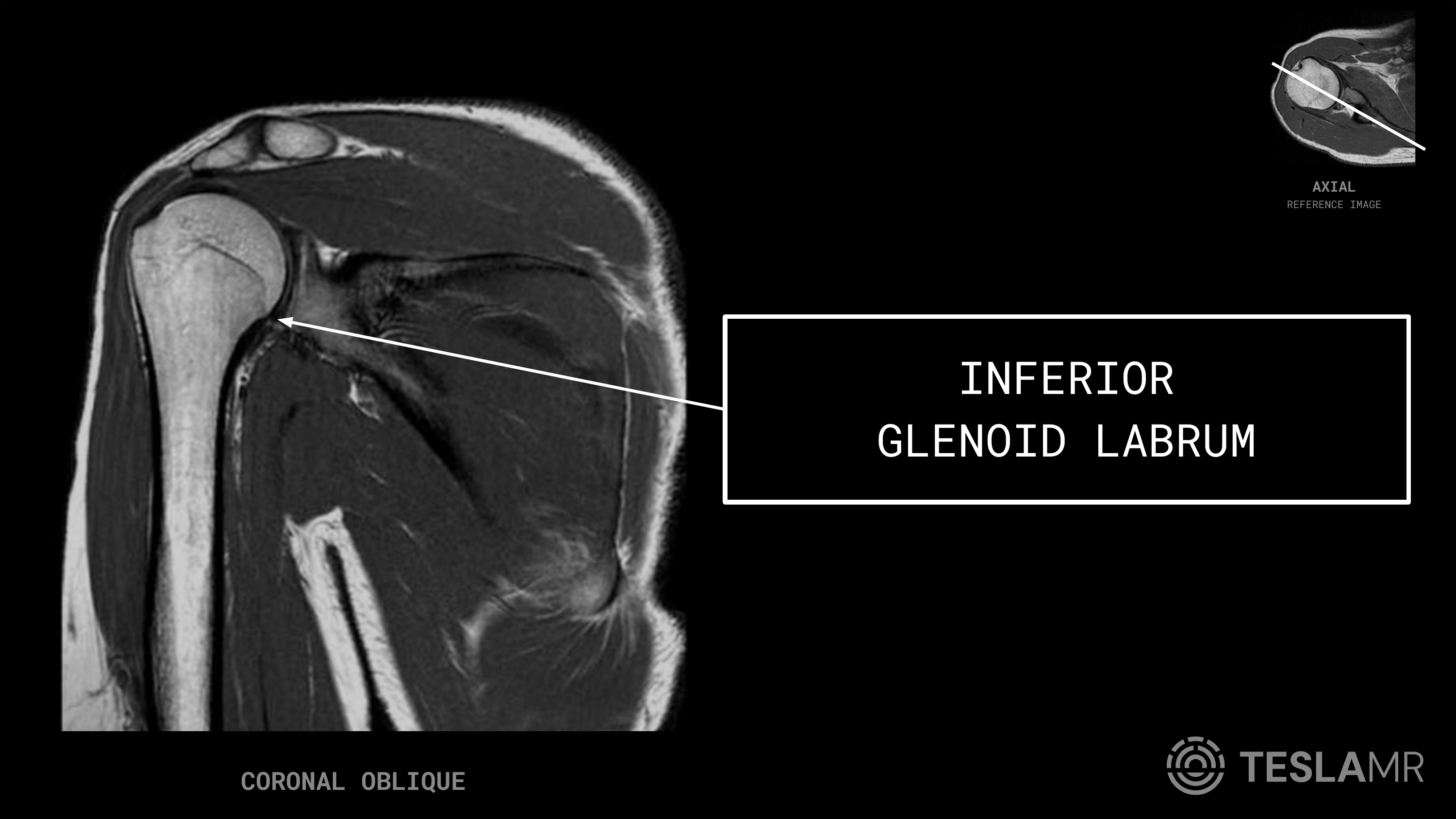 Inferior Glenoid Labrum labeled on a Shoulder MRI (Coronal Oblique)