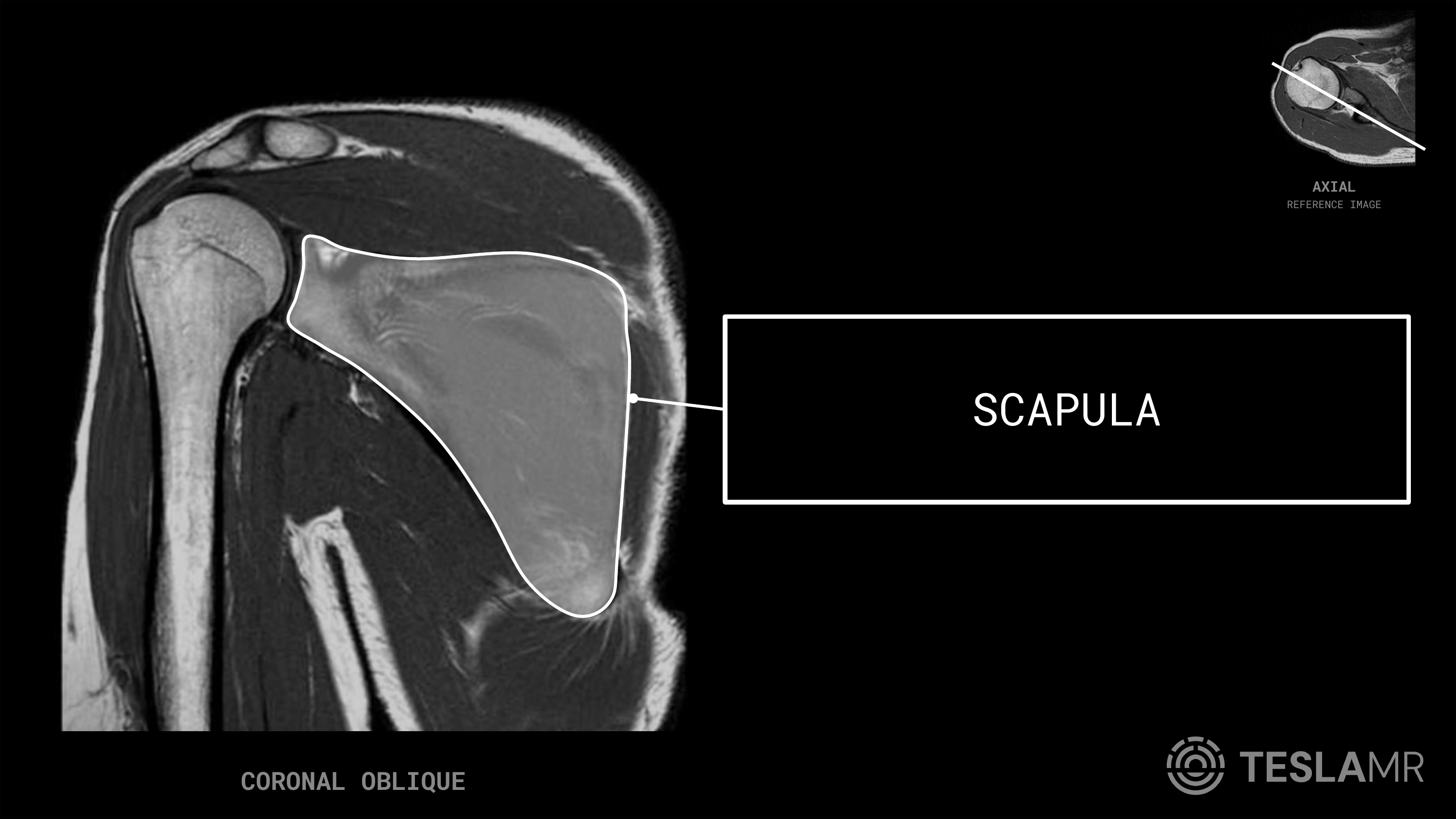 Scapula labeled on a Shoulder MRI (Coronal Oblique)