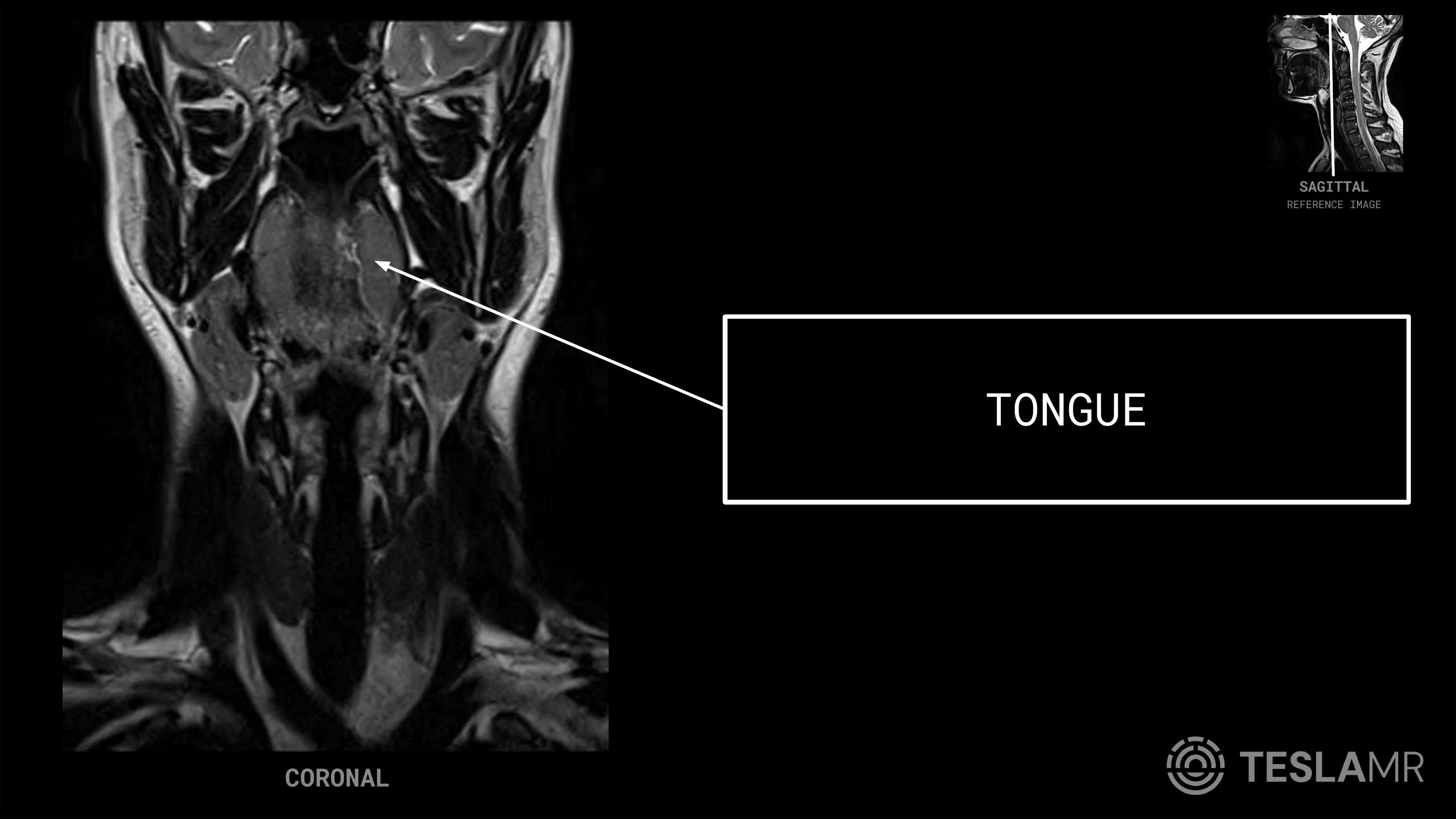 Tongue labeled on a Soft Tissue Neck MRI (Coronal · Sagittal)