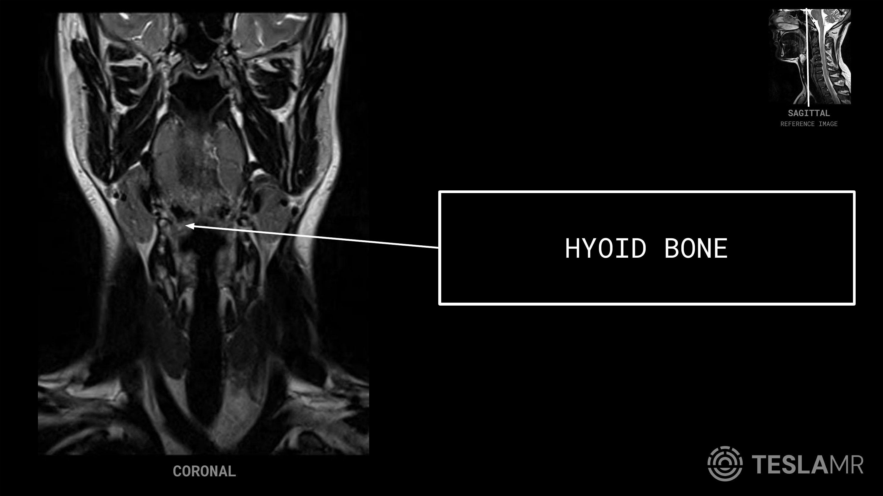 Hyoid Bone labeled on a Soft Tissue Neck MRI (Coronal · Sagittal)