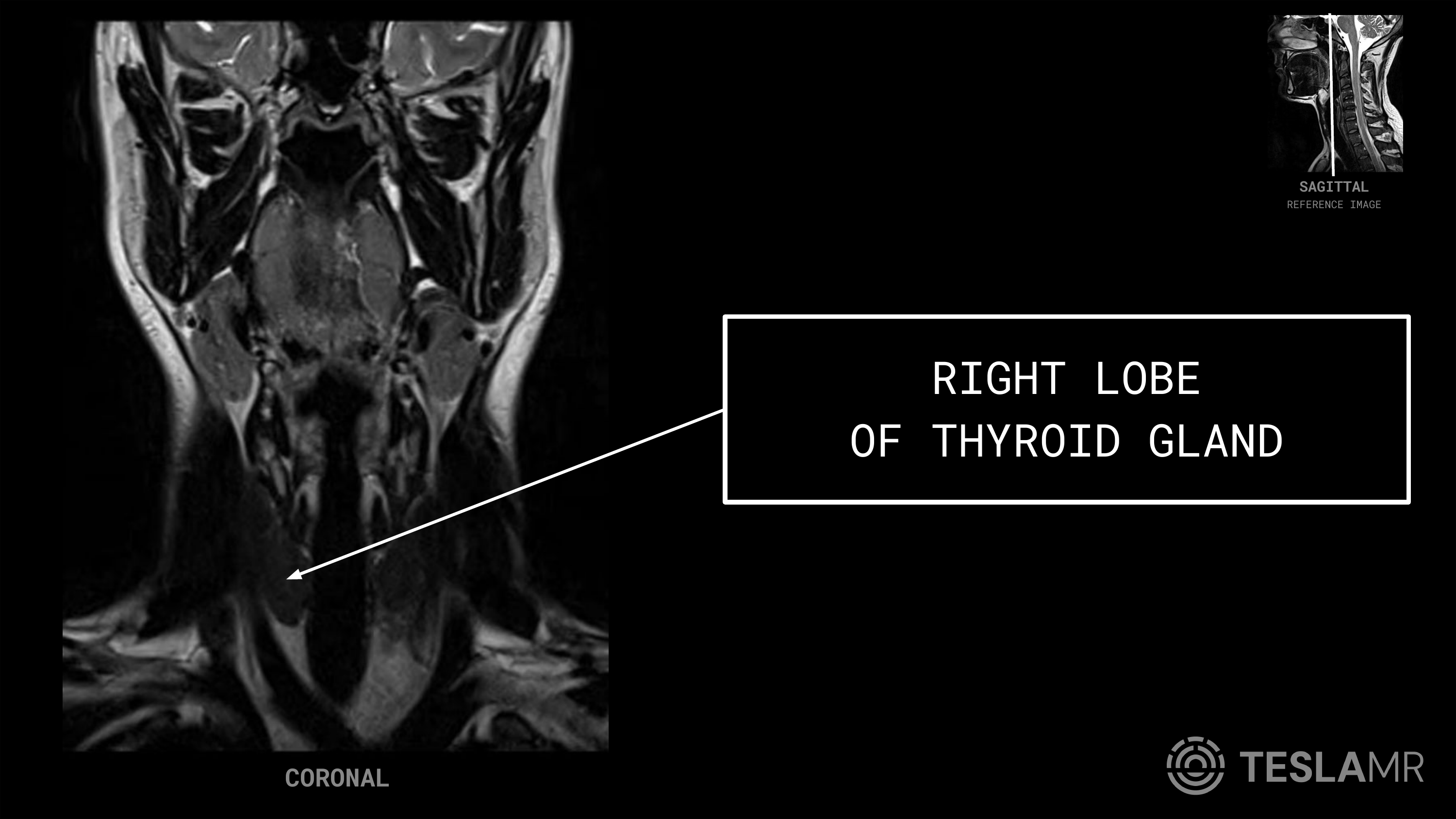 Right Lobe labeled on a Soft Tissue Neck MRI (Coronal)