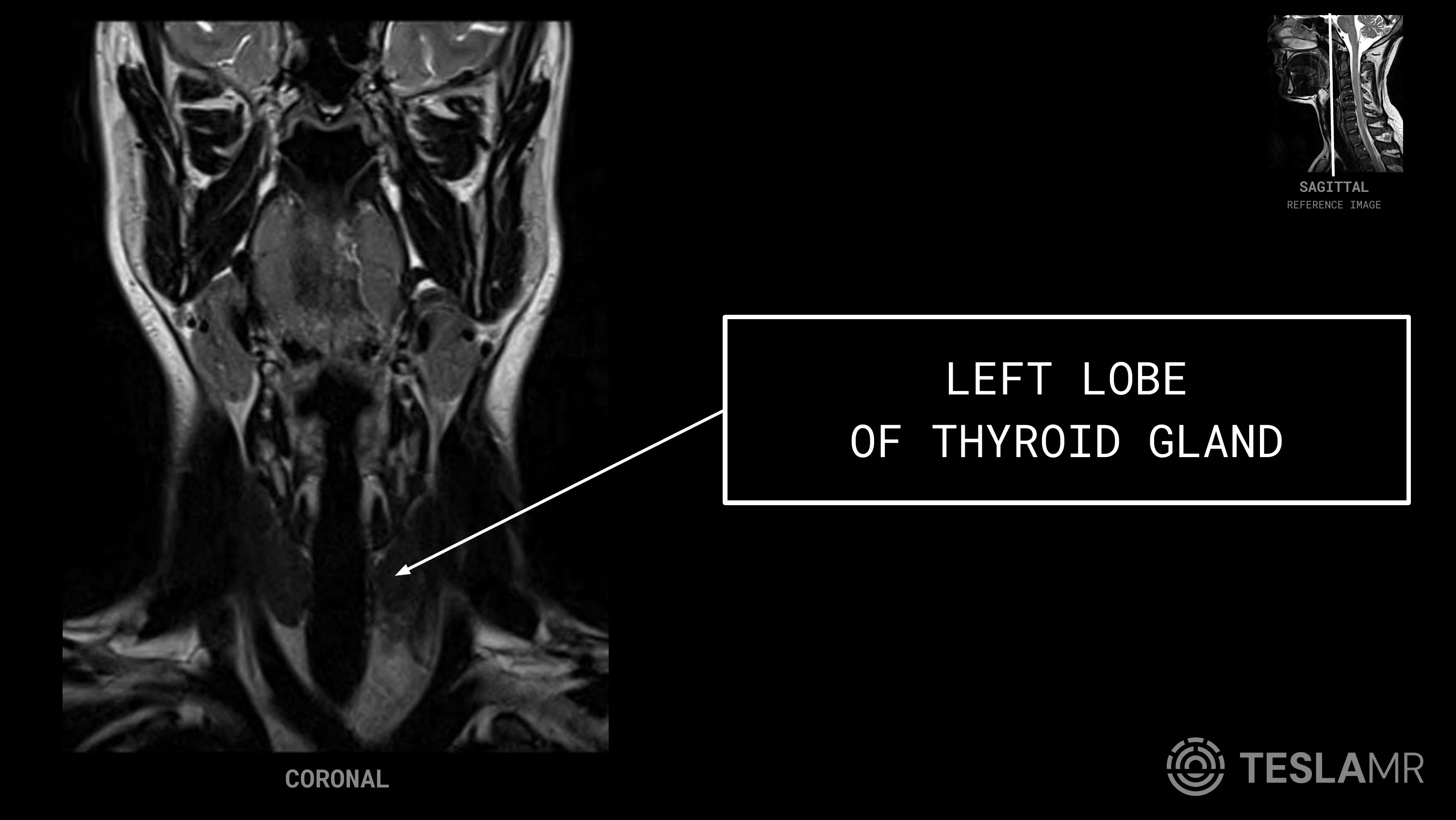 Left Lobe labeled on a Soft Tissue Neck MRI (Coronal)