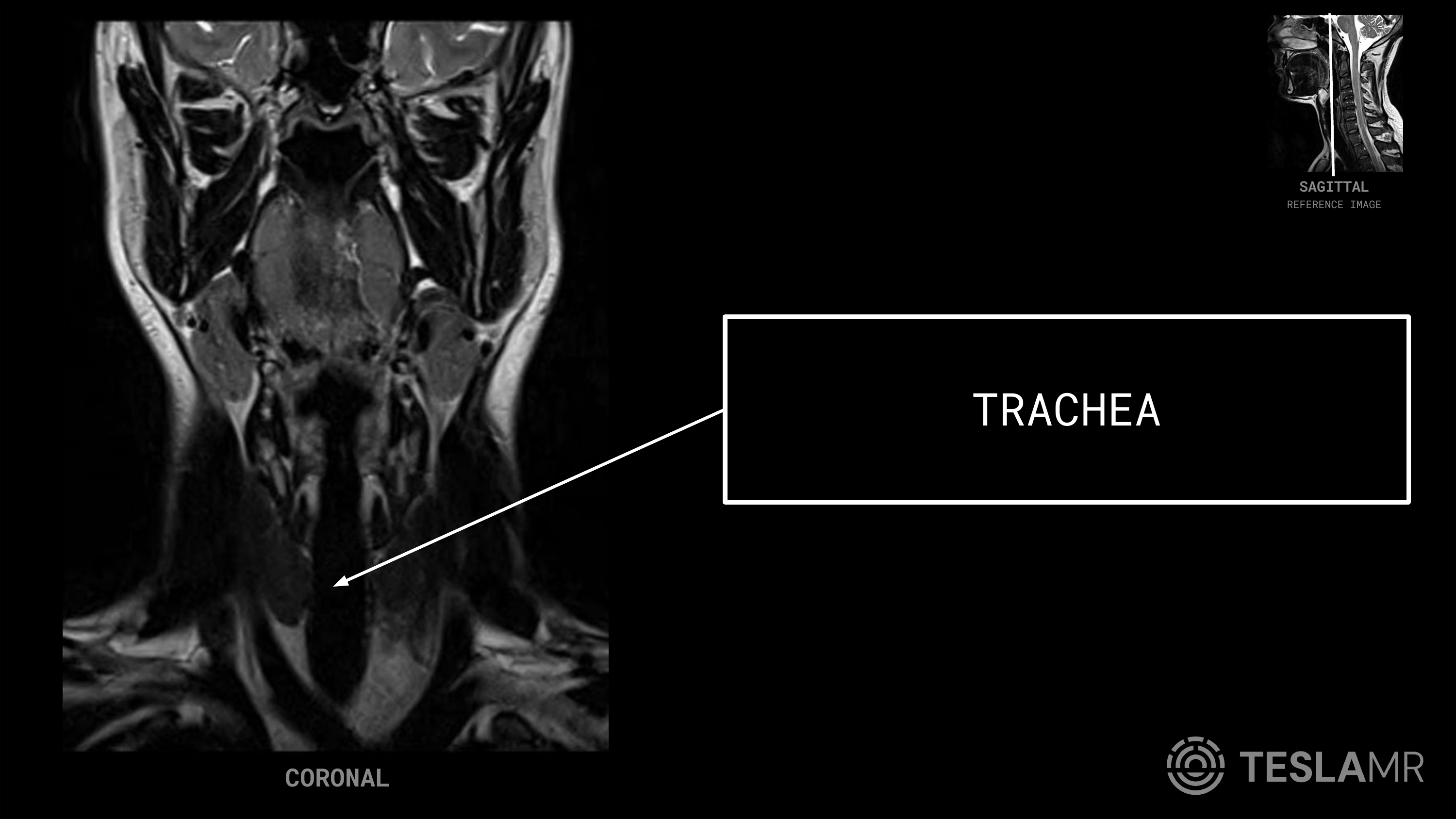 Trachea labeled on a Soft Tissue Neck MRI (Coronal · Sagittal)
