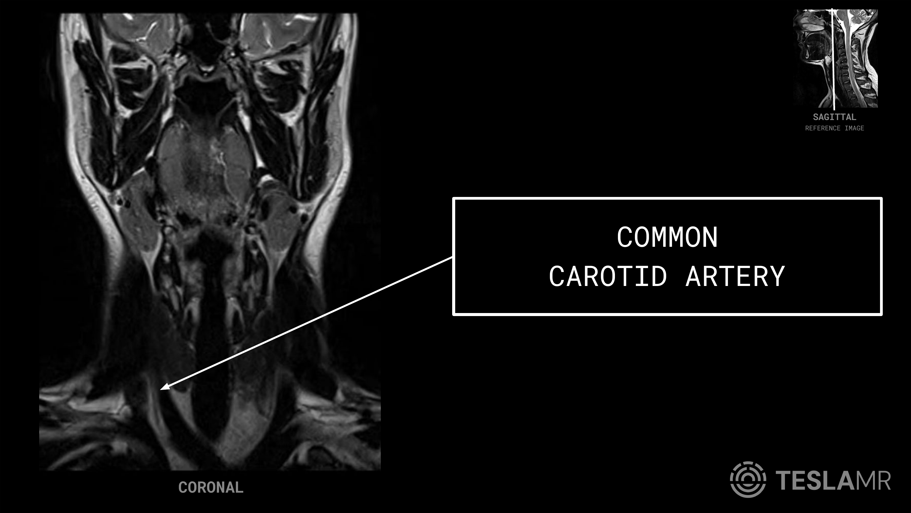 Common Carotid Artery labeled on a Soft Tissue Neck MRI (Coronal)