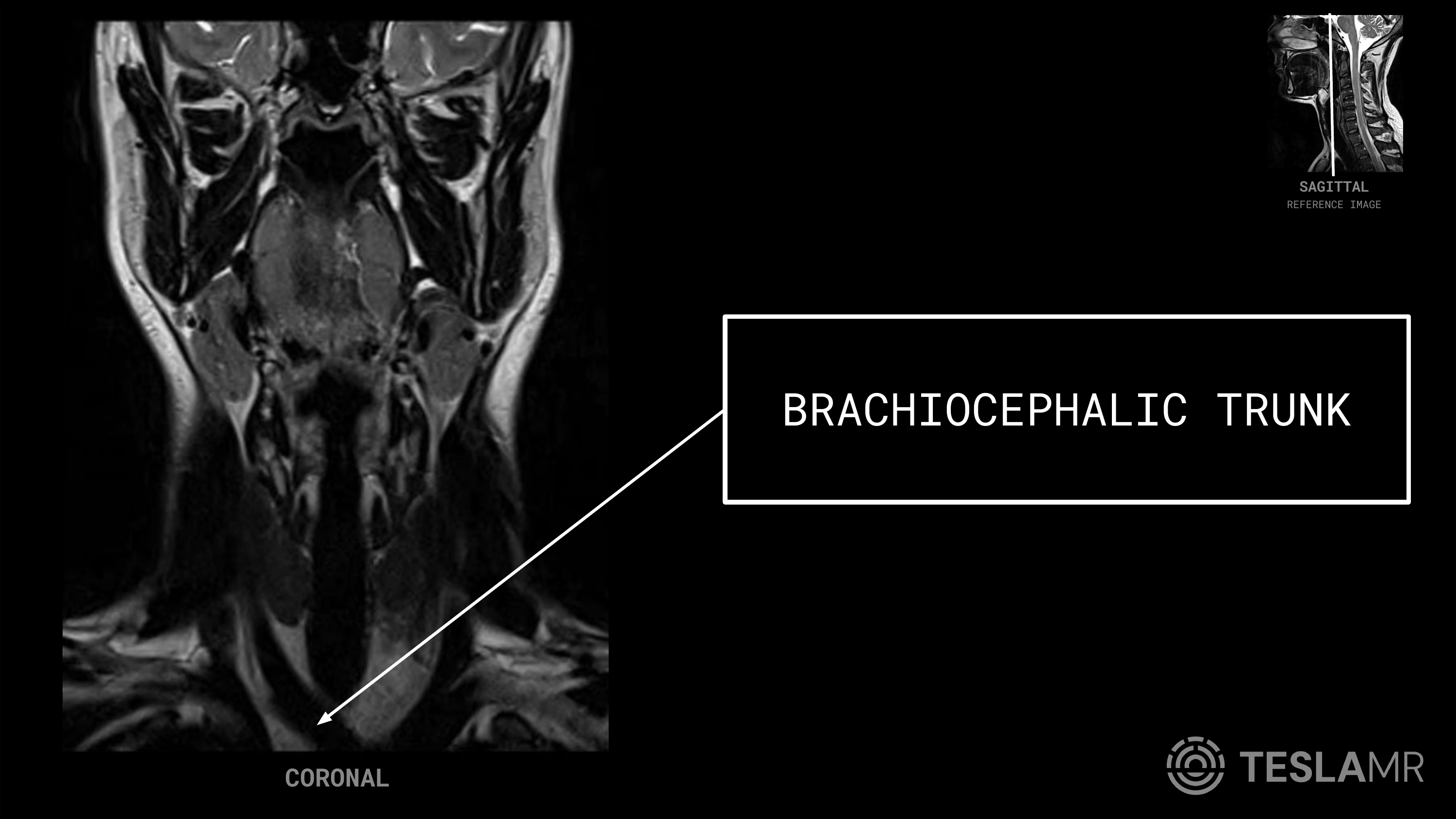 Brachiocephalic Trunk labeled on a Soft Tissue Neck MRI (Coronal)