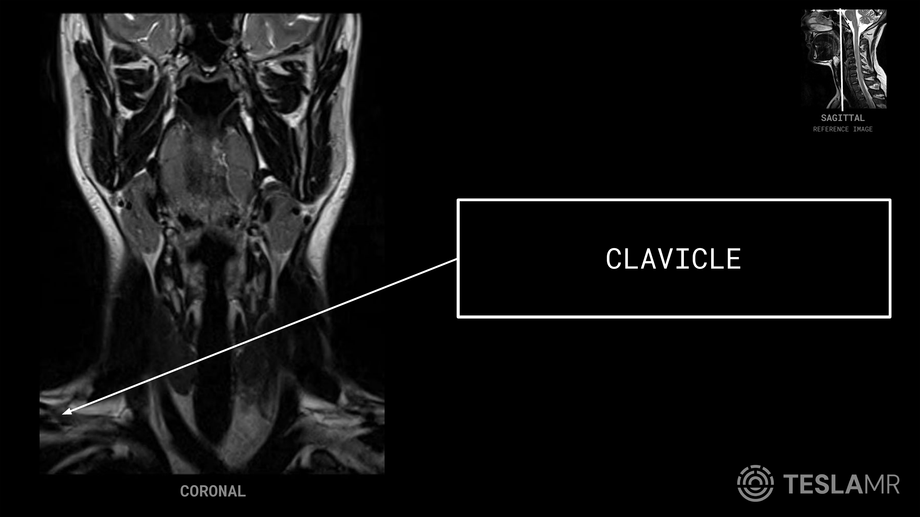 Clavicle labeled on a Soft Tissue Neck MRI (Coronal)