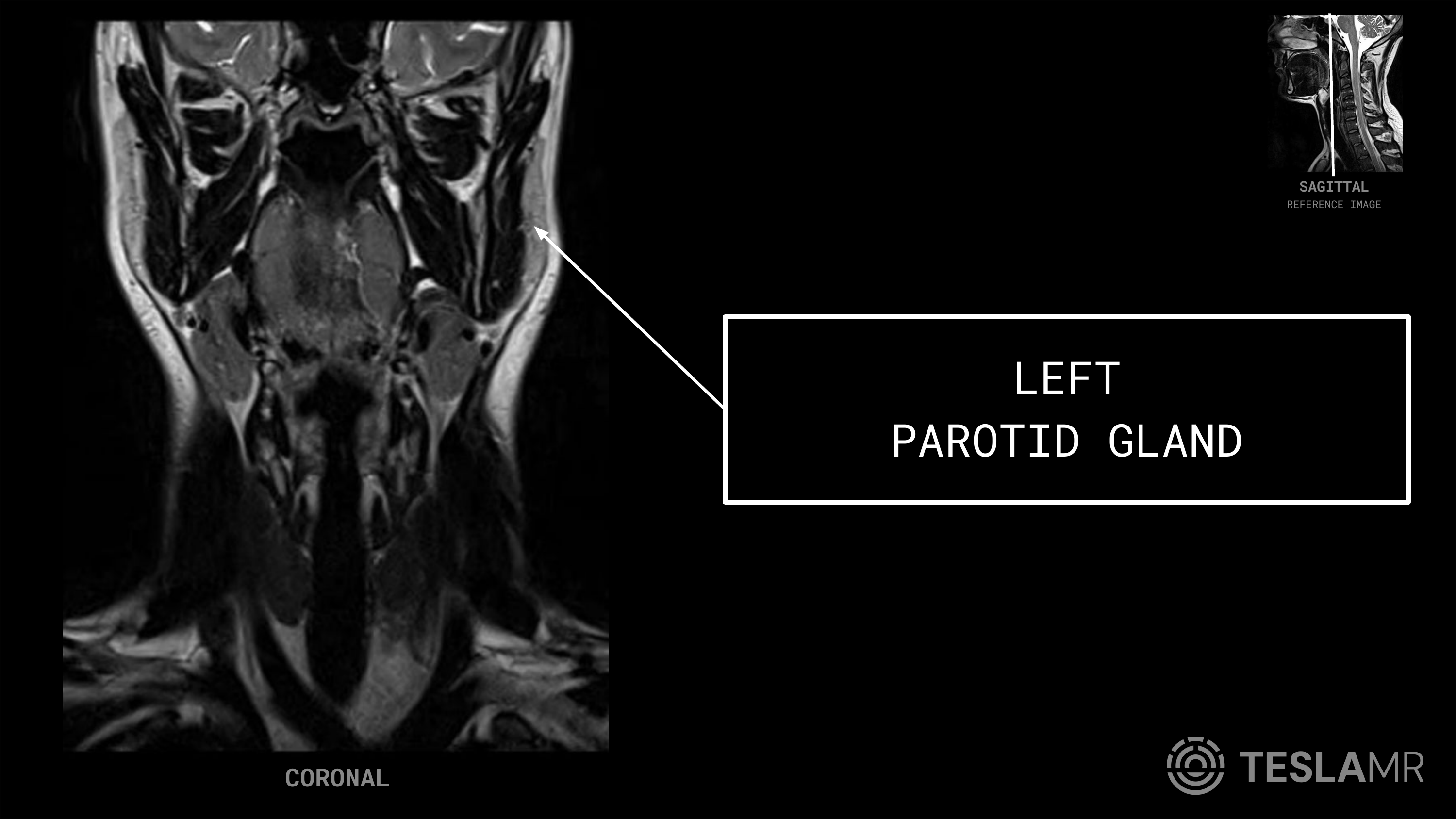 Left Parotid Gland labeled on a Soft Tissue Neck MRI (Coronal)