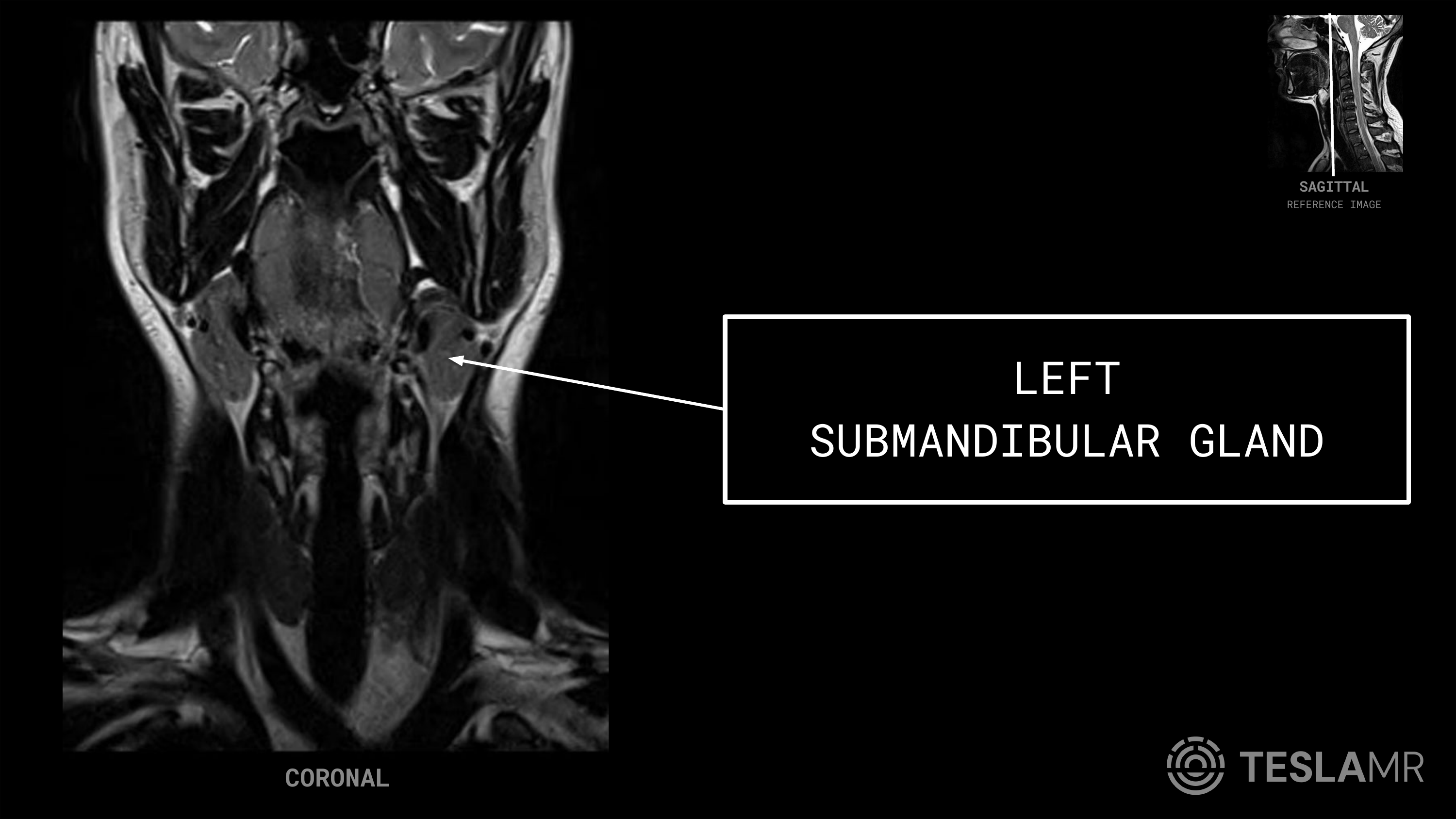 Left Submandibular Gland labeled on a Soft Tissue Neck MRI (Coronal)
