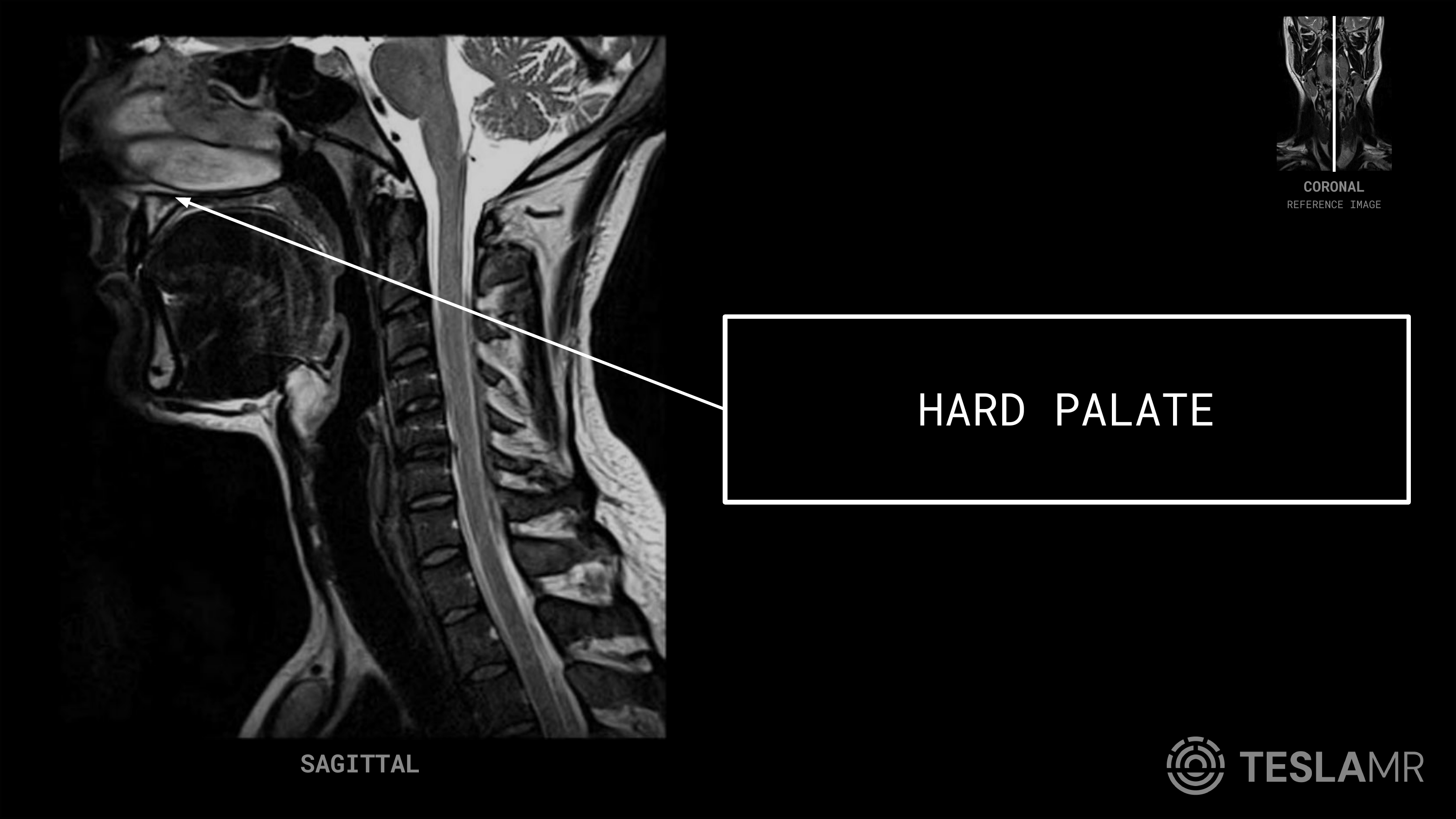 Hard Palate labeled on a Soft Tissue Neck MRI (Sagittal)
