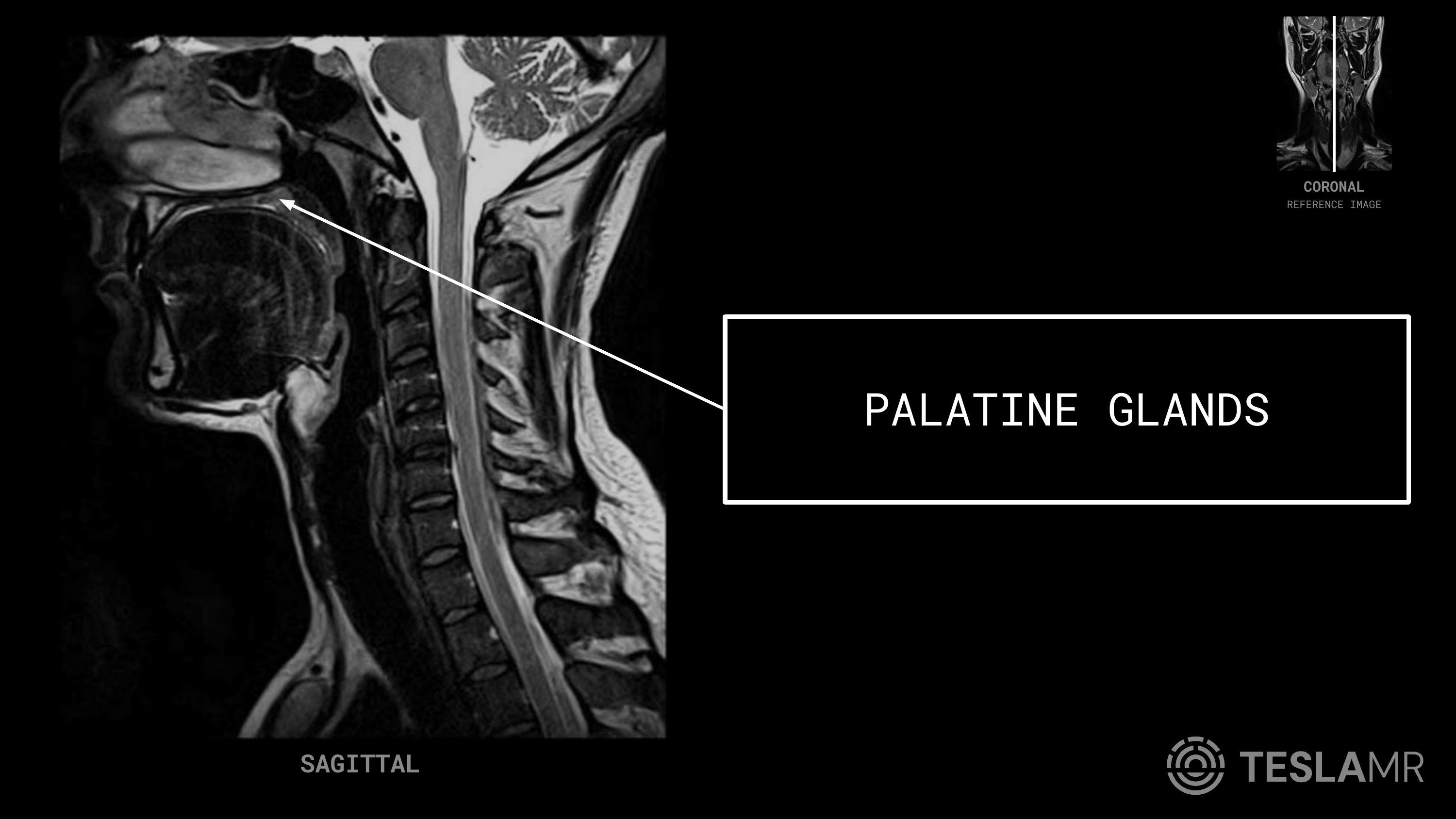 Palatine Glands labeled on a Soft Tissue Neck MRI (Sagittal)