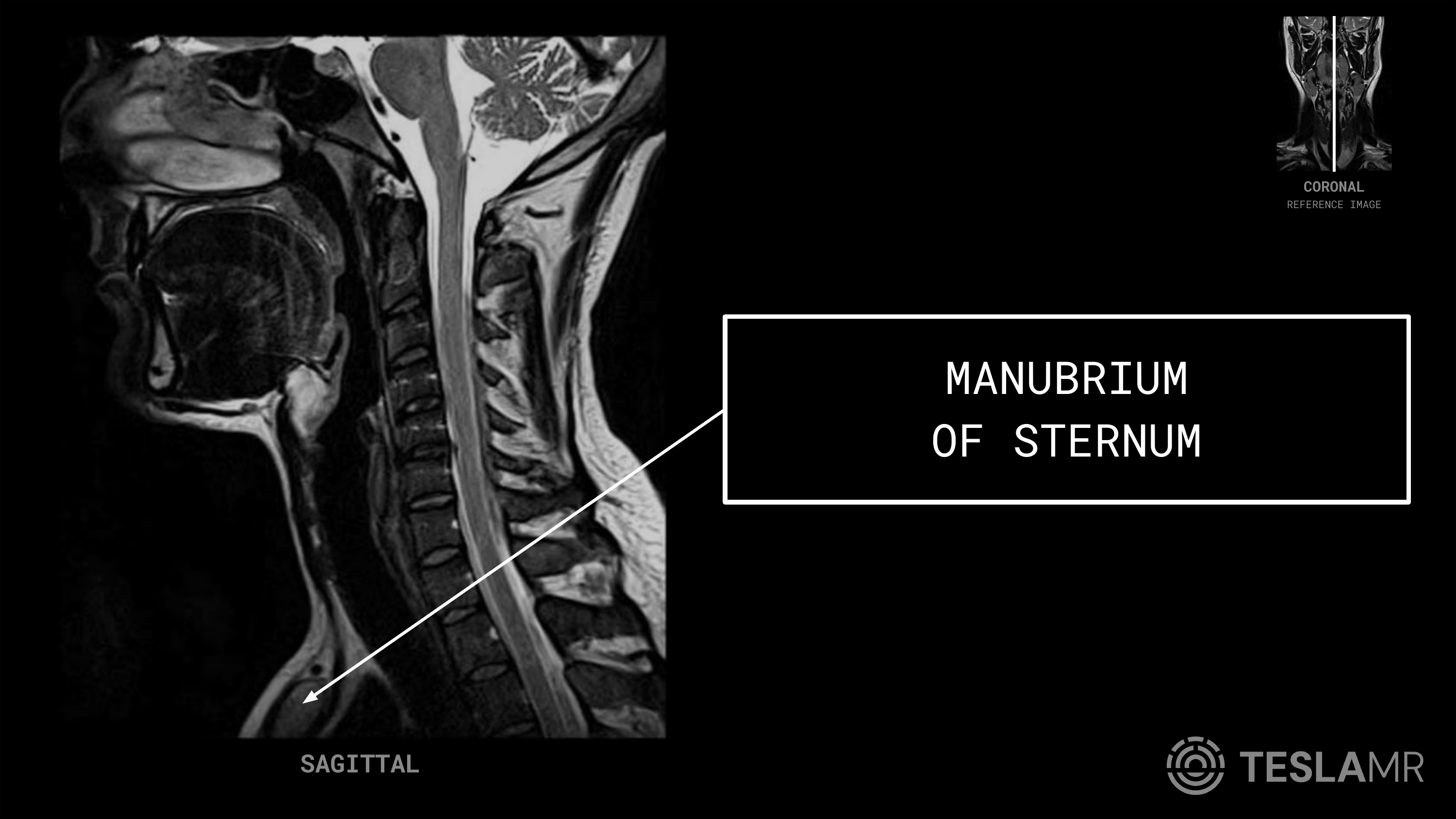 Manubrium labeled on a Soft Tissue Neck MRI (Sagittal)