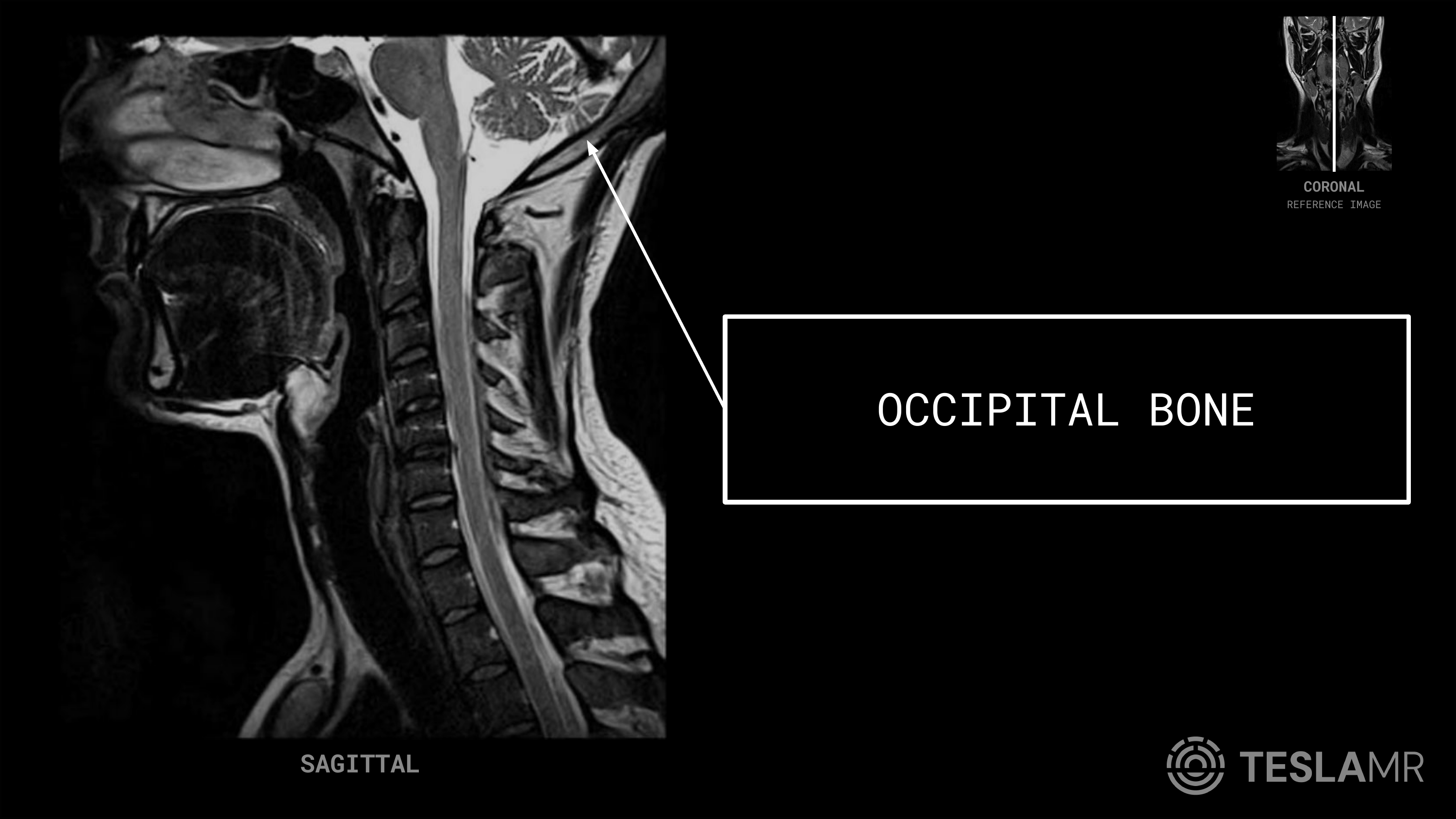 Occipital Bone labeled on a Soft Tissue Neck MRI (Sagittal)