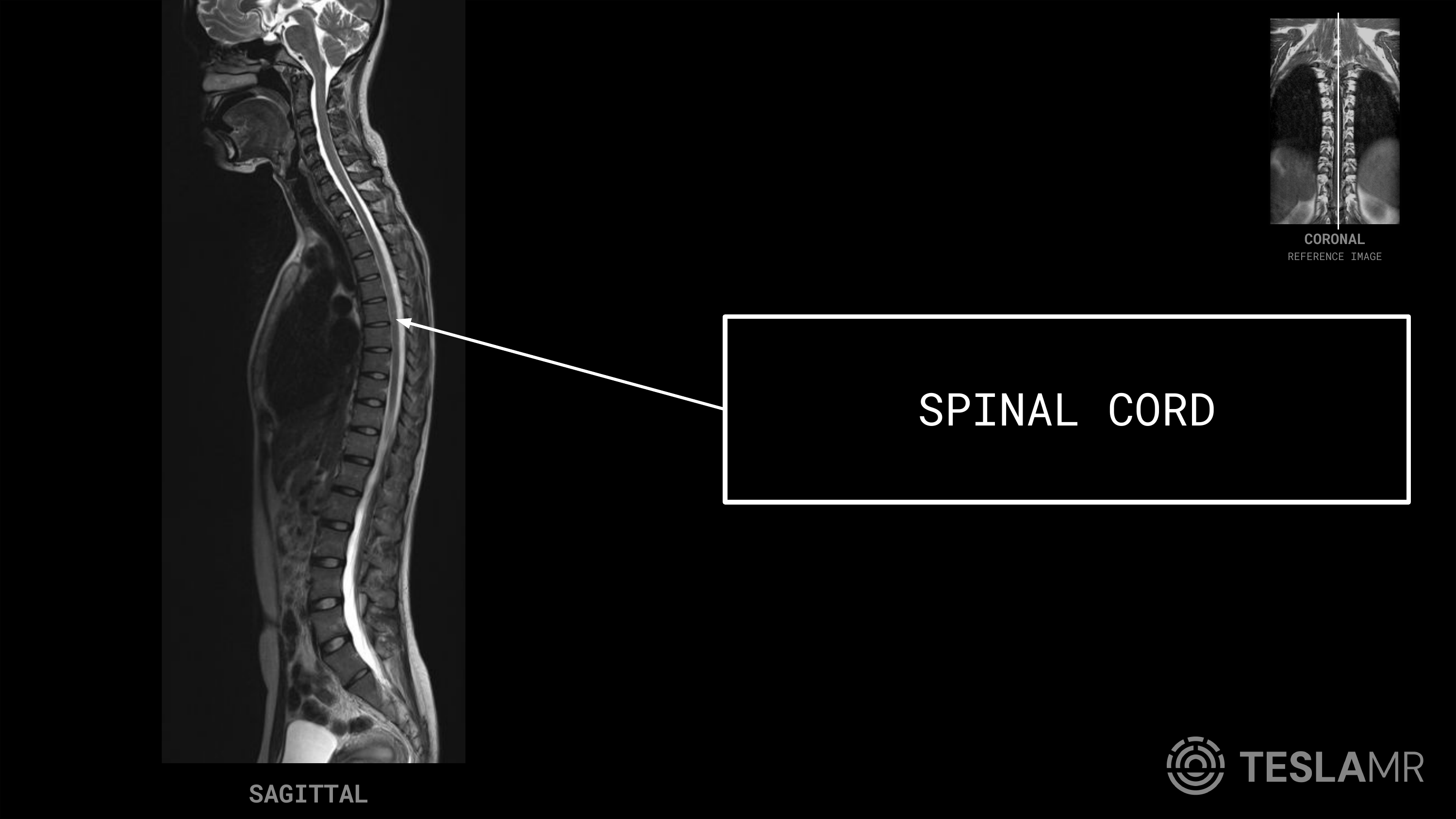 Spinal Cord labeled on a T-Spine MRI (Sagittal)